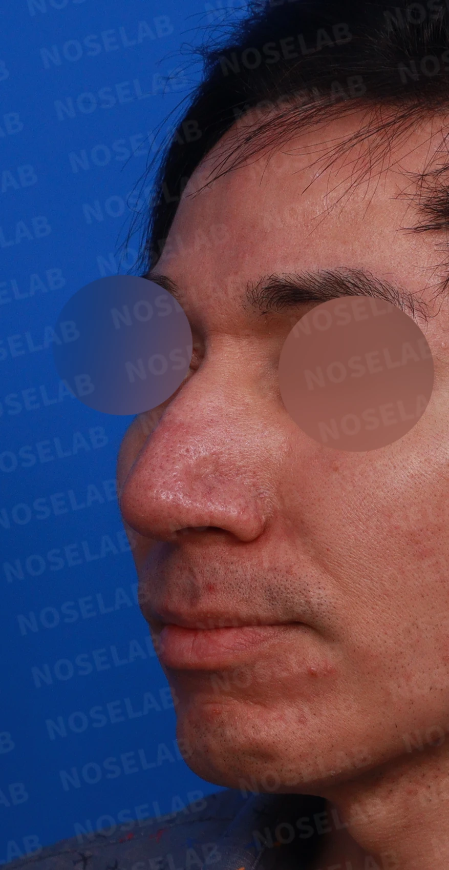 큰 코와 얼굴 비율을 함께 고려한 교정 방법 — 디자인 상담 정면, 좌측 측면, 비스듬한 측면 사진입니다.