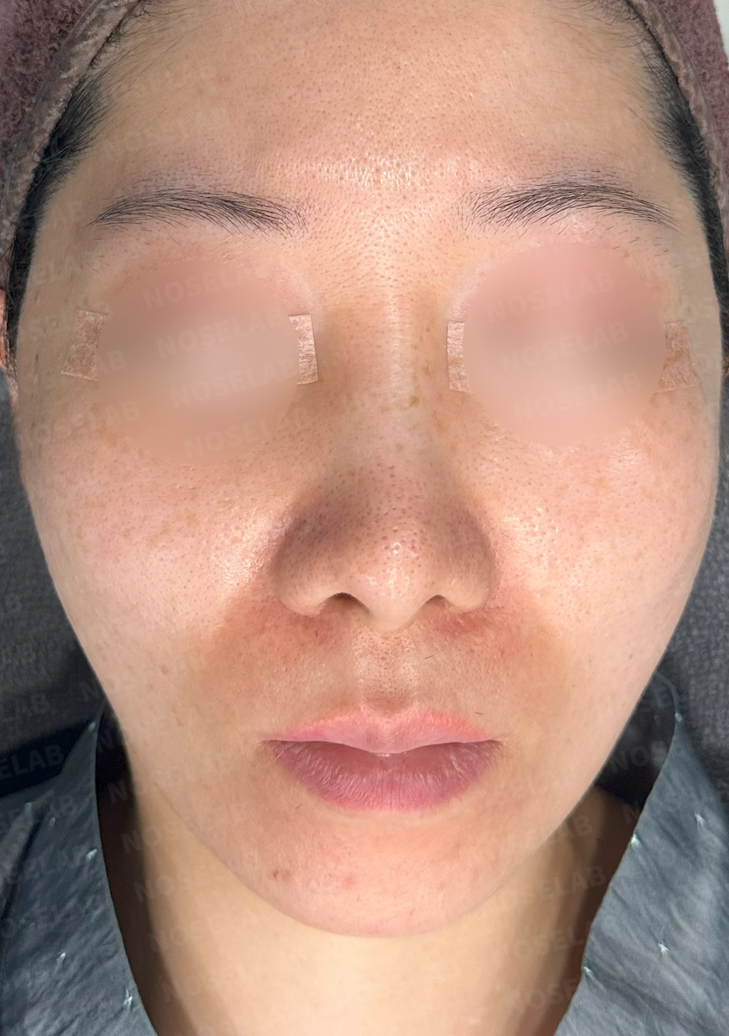콧대 시작점이 높고 코가 휘어 보이는 이유, 자가 늑연골 교정은 어떻게 하나 — 수술 전 / 수술 직후 0일 직후 사진은 부기가 있는 상태로 최종 결과와 다를 수 있습니다.