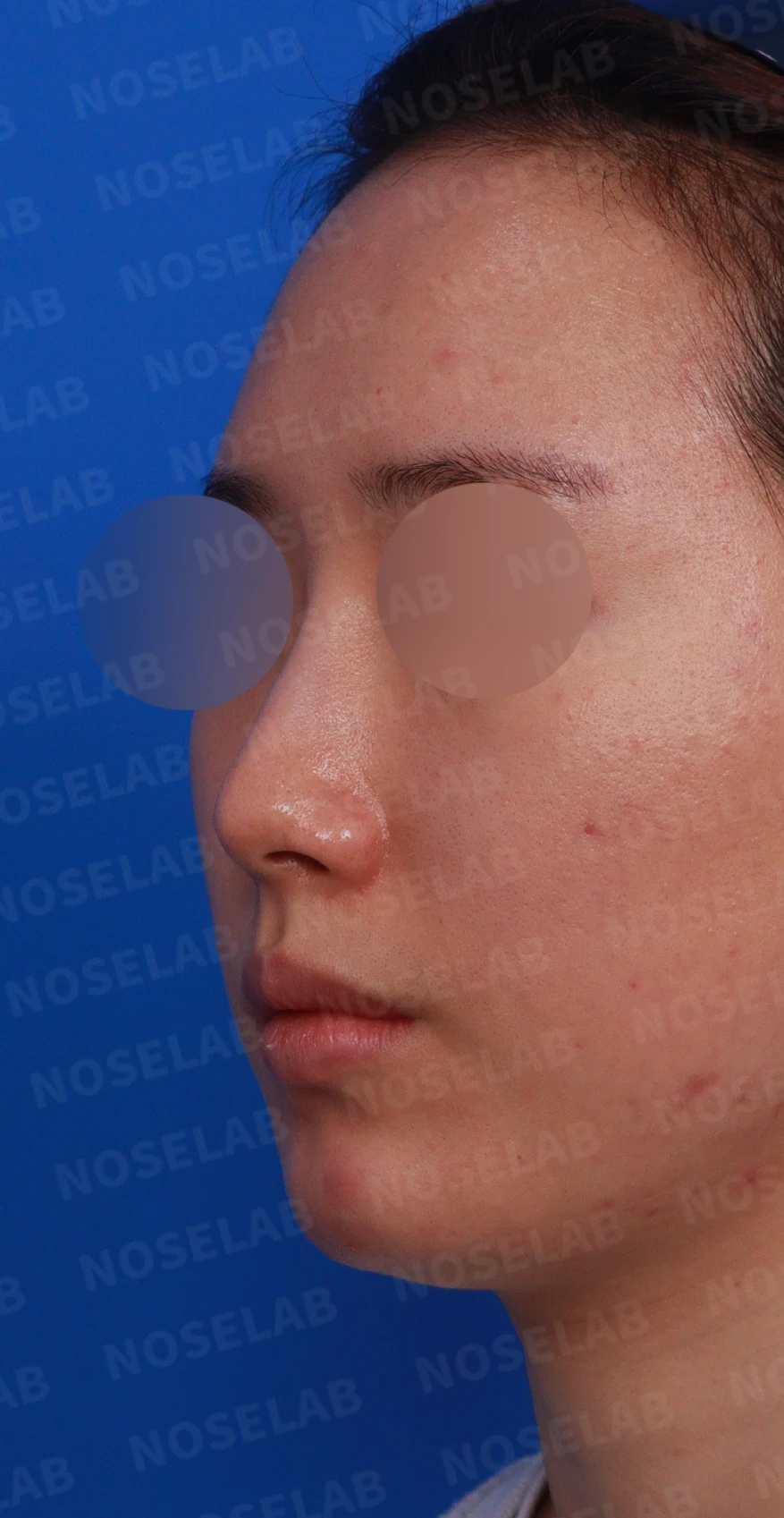 코 필러 뒤에도 휜 코와 코막힘이 남는 이유, 교정은 어떻게 하나 — 디자인 상담 정면, 좌측 측면, 비스듬한 측면 사진