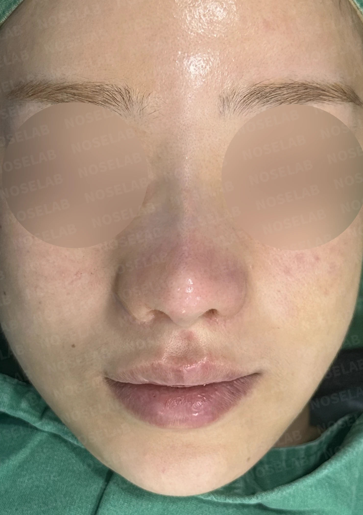여러 차례 수술 뒤에도 코막힘과 휜 코가 남는 이유 — 수술 직후 0일 정면, 비스듬한 측면, 측면 사진입니다. 직후 사진은 부기가 있는 상태로 최종 결과와 다를 수 있습니다.