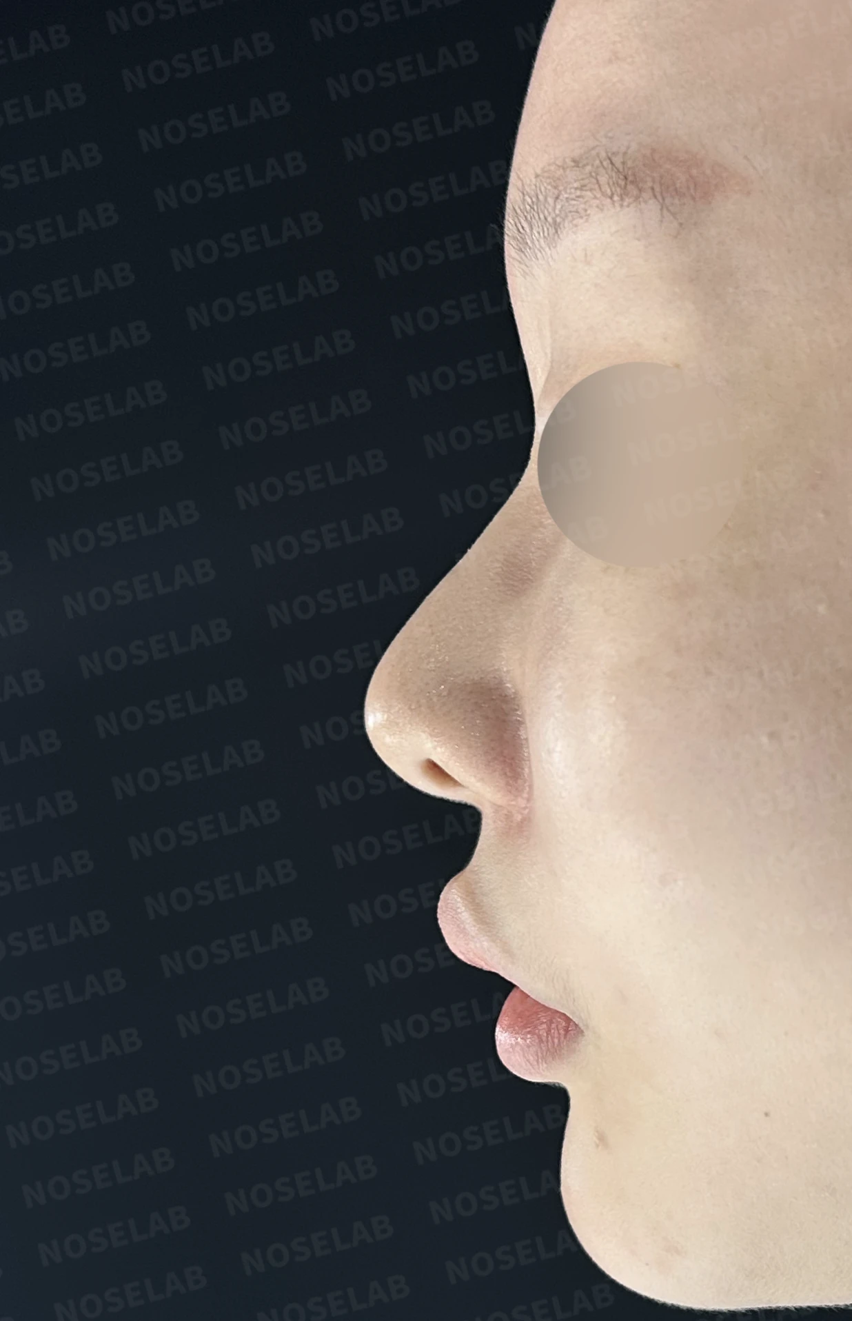 절골 부위가 과하게 깎이면 코가 왜 휘어 보이는가, 코뼈 복원과 코끝 재건 — 수술 전 / 수술 직후 0일 직후 사진은 부기가 있는 상태로 최종 결과와 다를 수 있습니다.