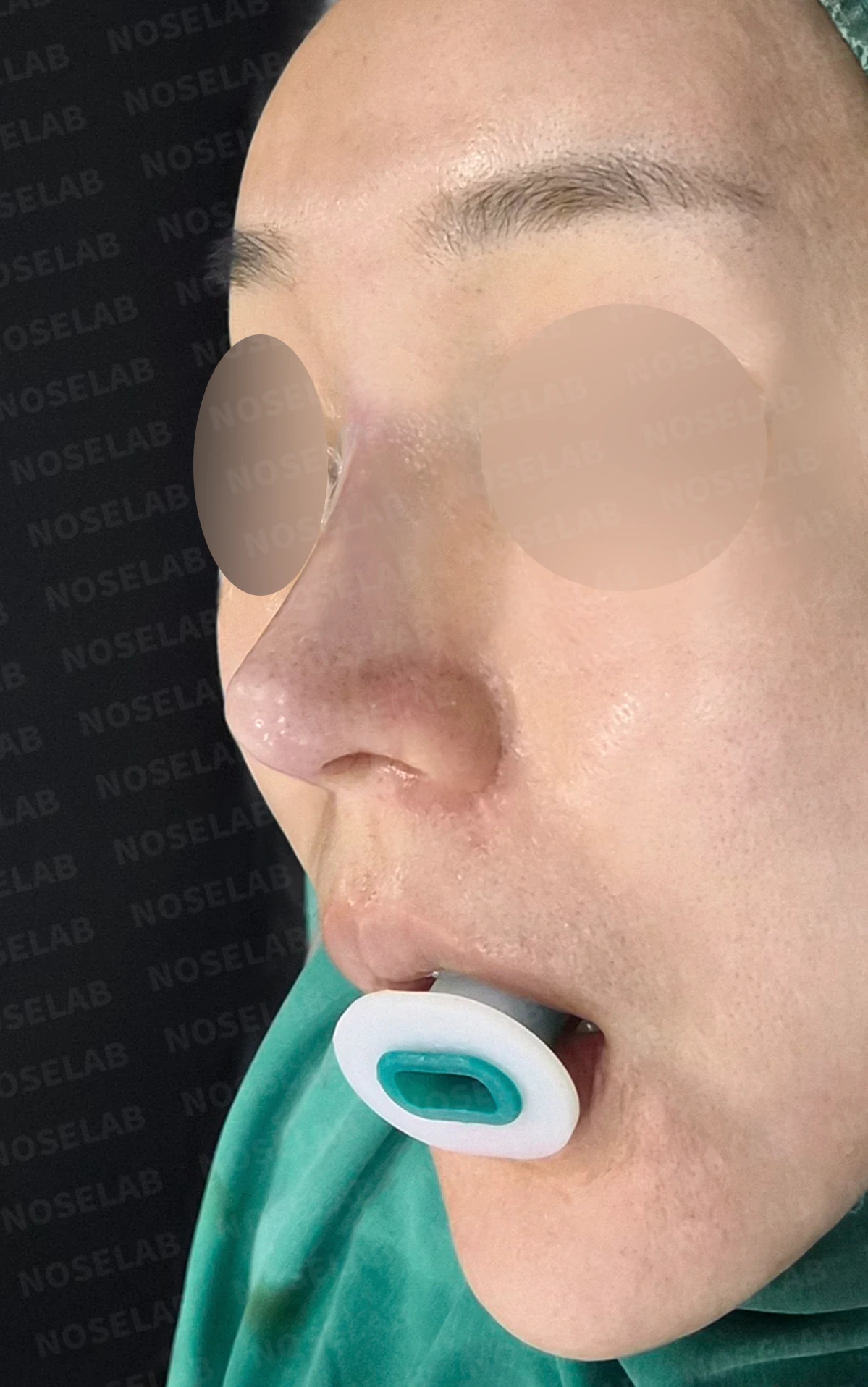 영구 필러가 코 모양을 바꾸는 과정과 제거 후 재건 방법 — 수술 직후 0일 정면, 비스듬한 측면, 측면 사진입니다. 직후 사진은 부기가 있는 상태로 최종 결과와 다를 수 있습니다.