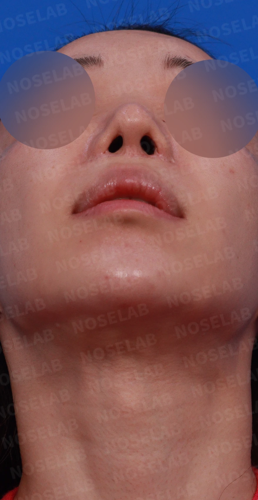 콧구멍 비대칭과 협착이 생기는 이유, 늑연골 재건과 Z성형은 어떻게 하나 — 디자인 상담 우측 비스듬한 측면, 측면, 비공 사진입니다.