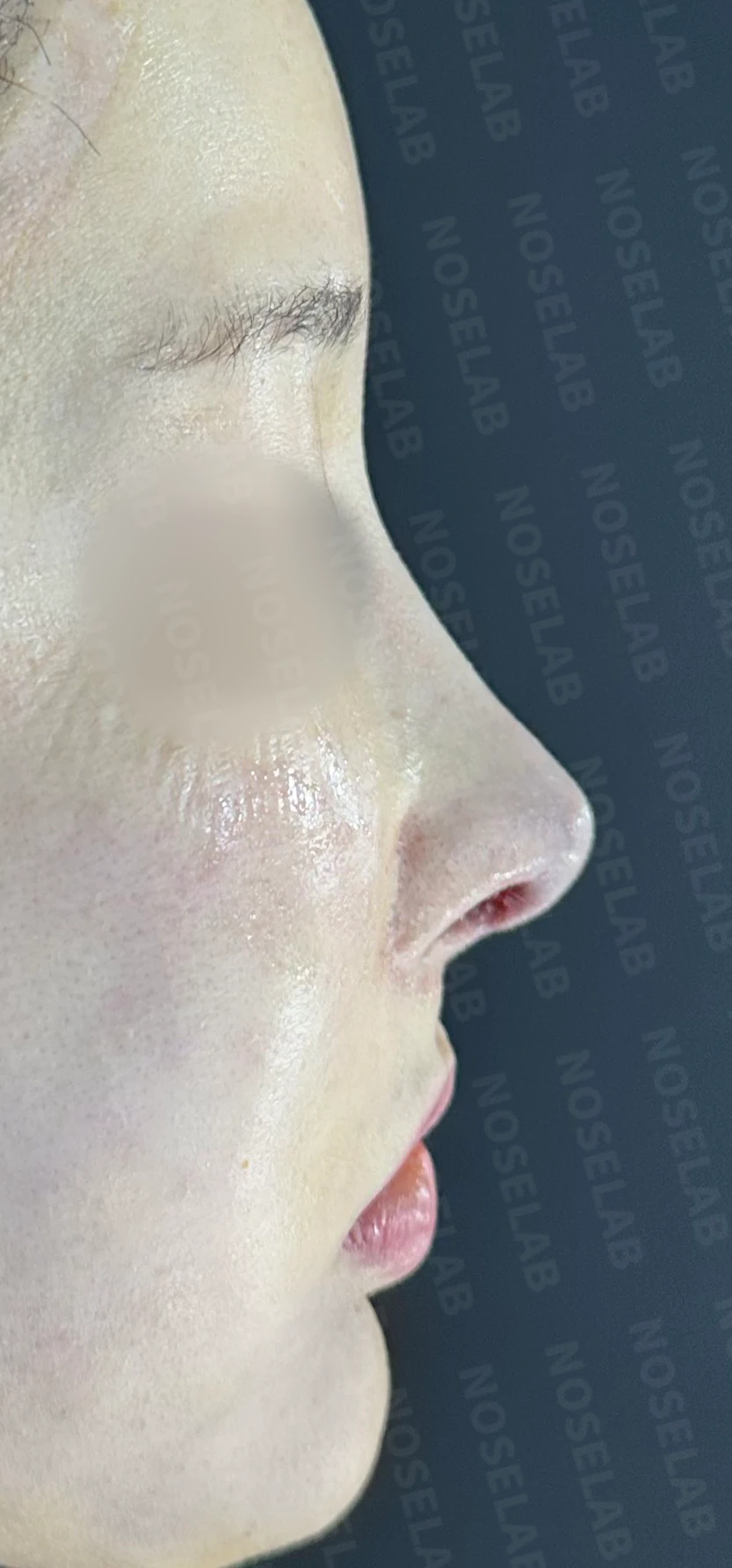 수술 후 14일 조기 교정에서 확인할 점 — 수술 직후 0일 사진 90도, 45도, 정면 직후 사진은 부기가 있는 상태로 최종 결과와 다를 수 있습니다.