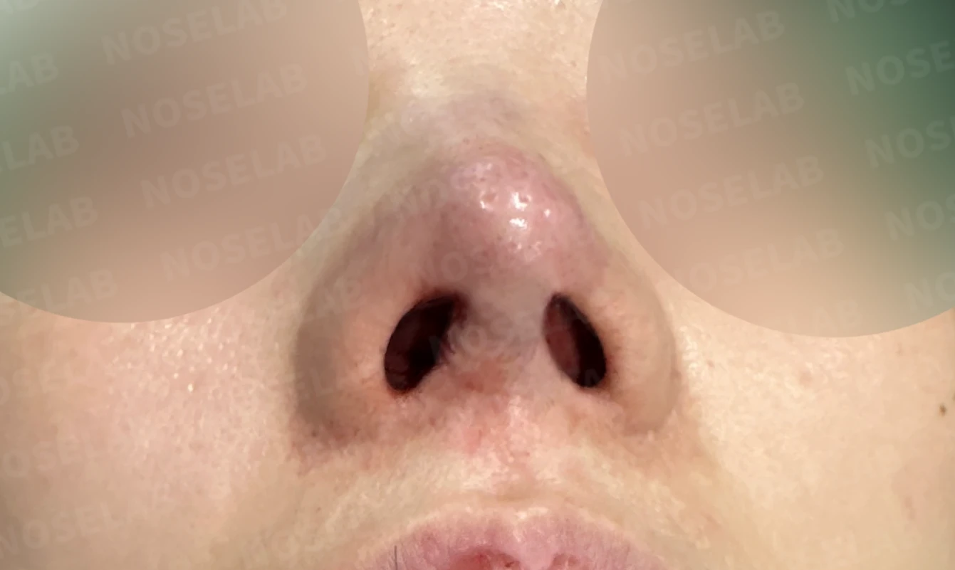 휘어진 코와 퍼진 코끝, 자가늑연골로 세련된 직반라인 완성한 코재수술 — 직후 비공 사진입니다.