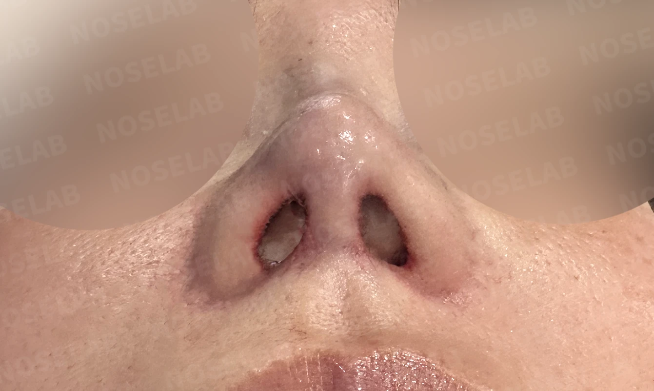 실리콘 재수술, 자가늑연골로 안전하게 코 라인 교정한 사례 — 전(좌) 직후(후)