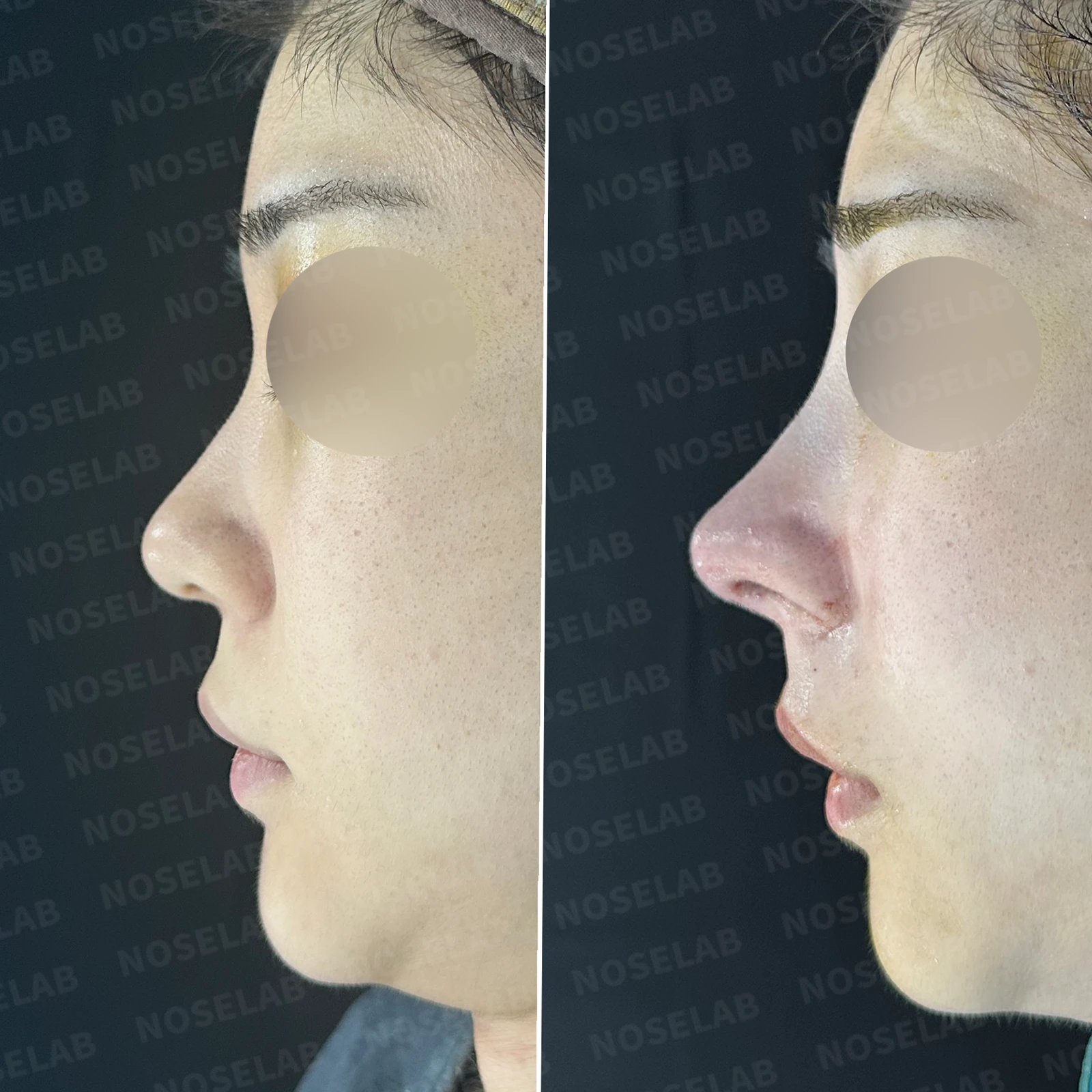코가 뭉툭하고 퍼져 보이는 이유, 비순각과 비주는 어떻게 교정하나 — 본문 사진 20