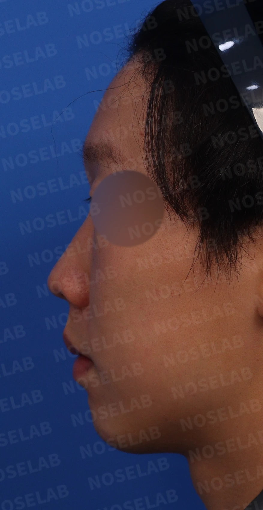 들린코, 작은코, 비순각 교정 사례 - 기능과 미용을 동시에 잡다 — 수술전 디자인 상담 정면, 좌측 비스듬한 측면, 측면 사진입니다.