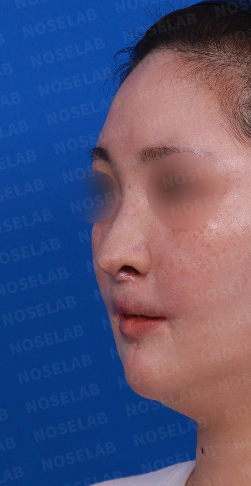 구순구개열에서 코 비대칭이 남는 이유와 늑연골·귀연골 재건 방법 — 디자인 상담 정면 , 좌측 비스듬한 측면 , 측면 사진입니다.