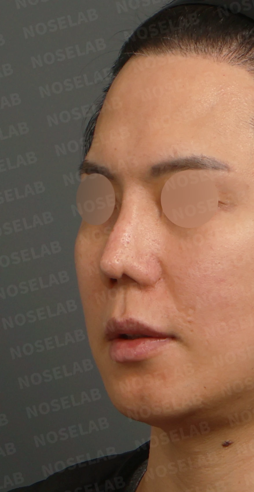 여러 차례 코재수술 후 구축 변형, 자가늑연골로 재건한 사례 — 디자인 상담 정면, 좌측 측면, 비스듬한 측면 사진입니다.