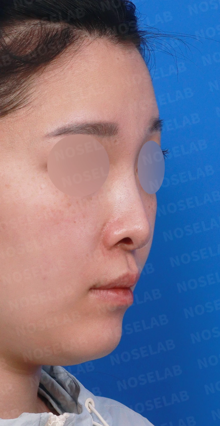처진 비주 교정, 휜 코와 비공 비대칭까지 완벽하게 — 디자인 상담 우측 측면, 비스듬한 측면, 비공 사진입니다.