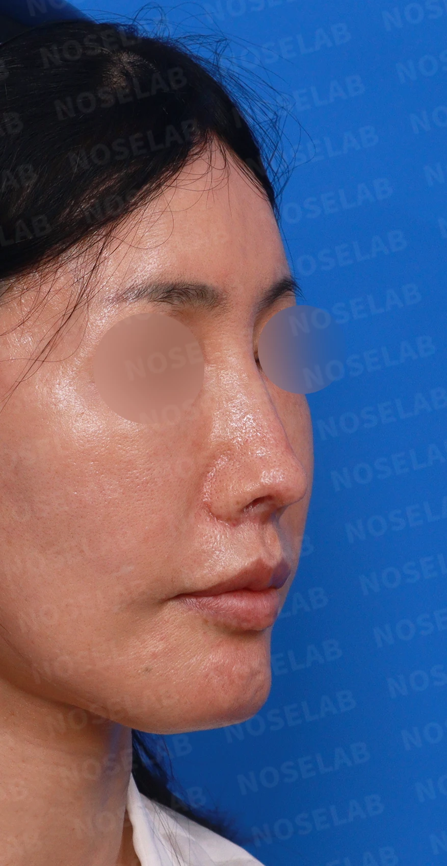 여러 차례 수술 뒤 비중격이 손상되면, 늑연골 재건은 어떻게 하나 — 디자인 상담 우측 측면, 비스듬한 측면, 비공 사진입니다.