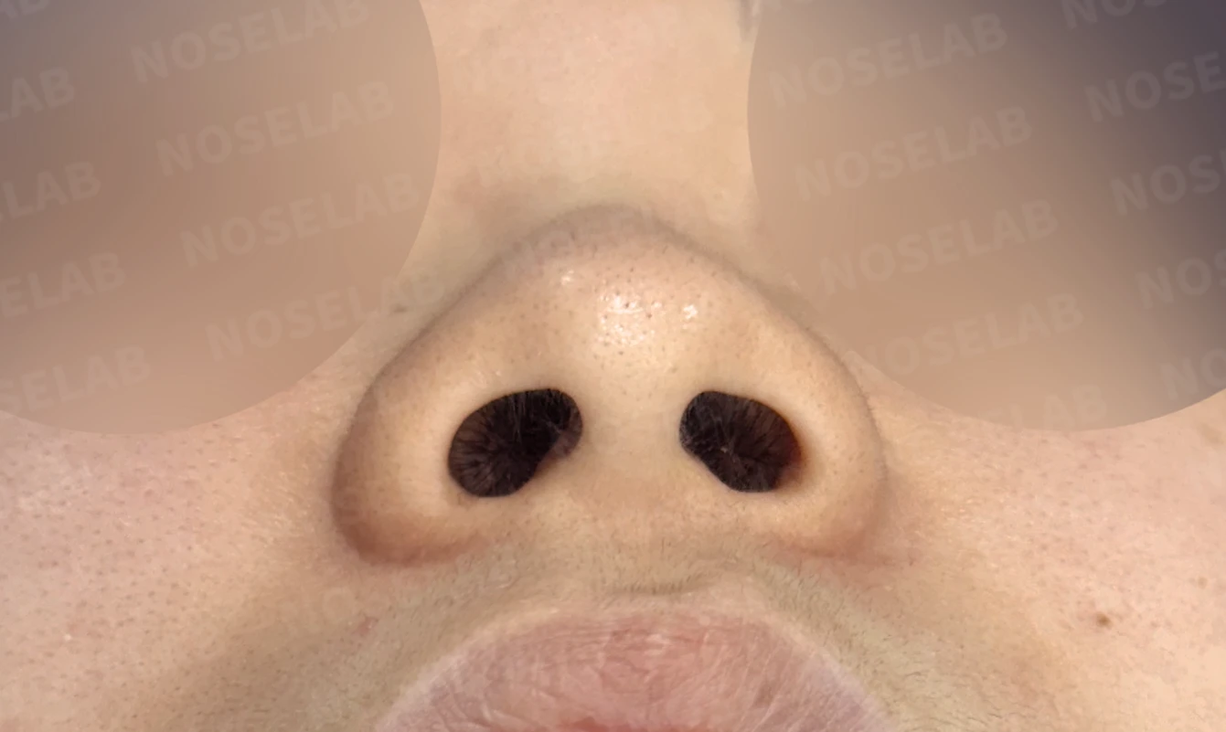 안면 비대칭과 휜코, 자가늑연골 비중격 재건으로 자연스럽게 교정한 코성형 — 전(좌) 직후(후)
