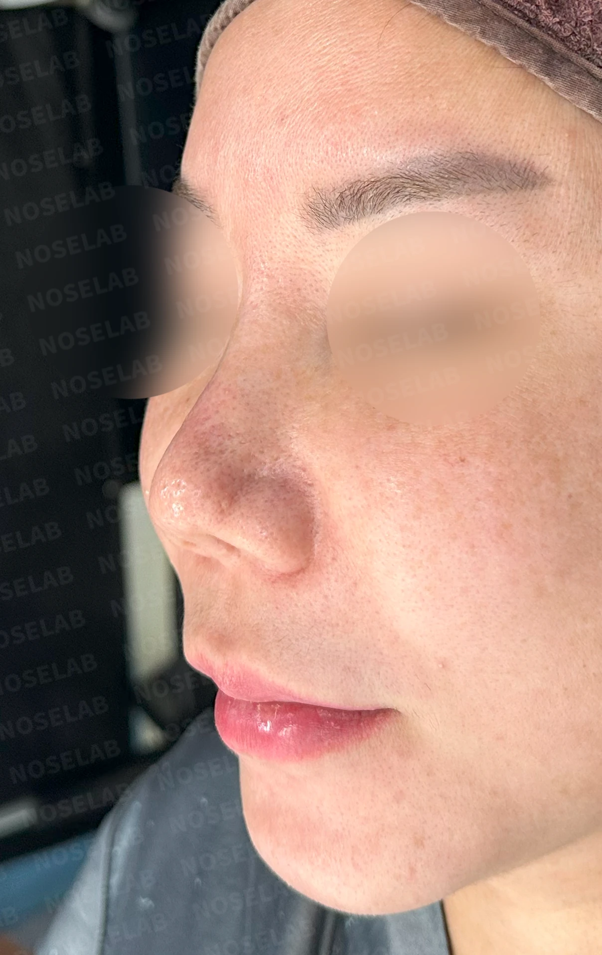 코끝이 찝히고 비주가 함몰되는 이유, 메드포어 제거와 재건은 어떻게 하나 — 수술 전 / 수술 직후 0일 직후 사진은 부기가 있는 상태로 최종 결과와 다를 수 있습니다.