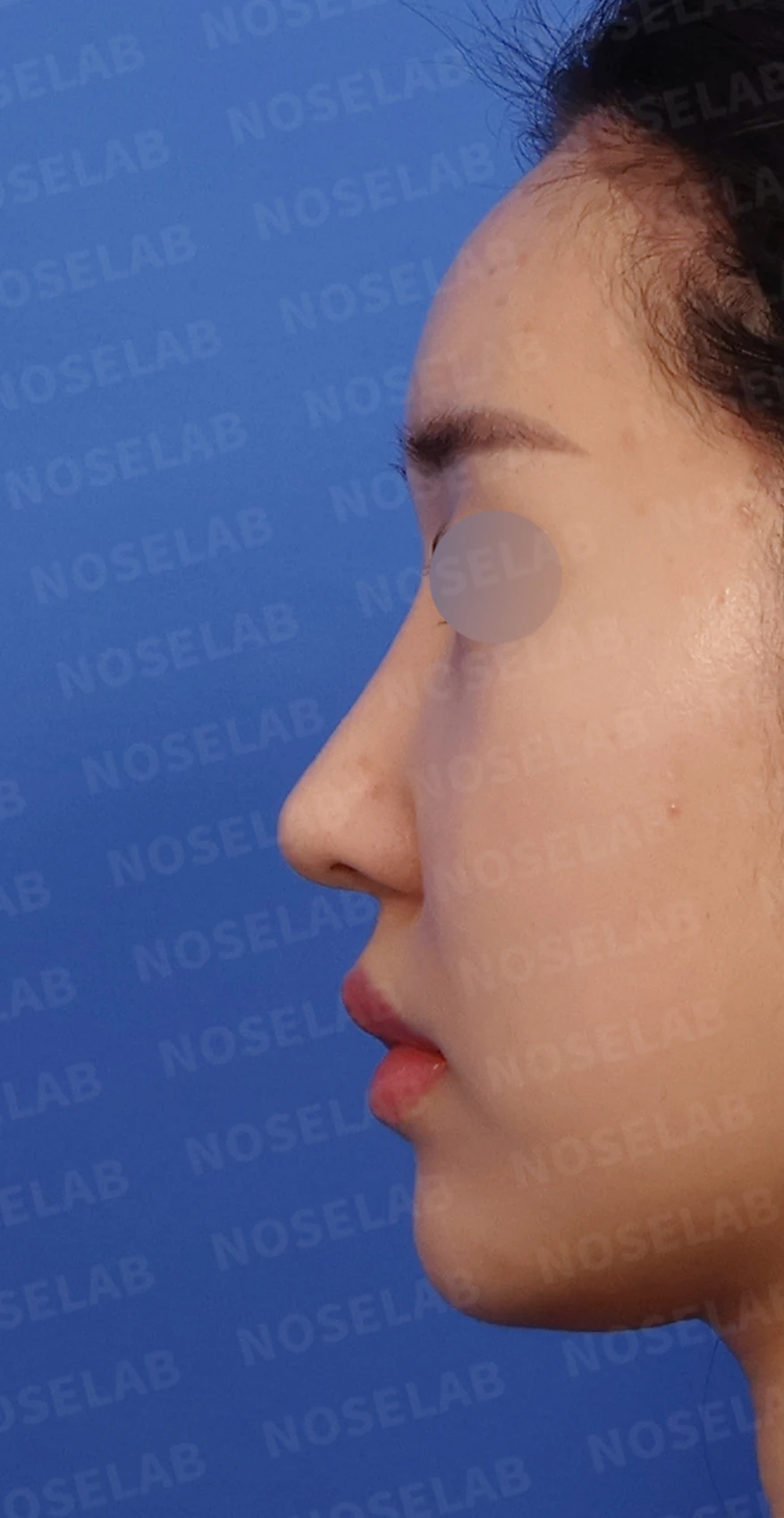 화살코와 복코가 함께 있는 코, 비중격 재건부터 시작하는 이유 — 디자인 상담 정면, 좌측 측면, 비스듬한 측면 사진입니다.