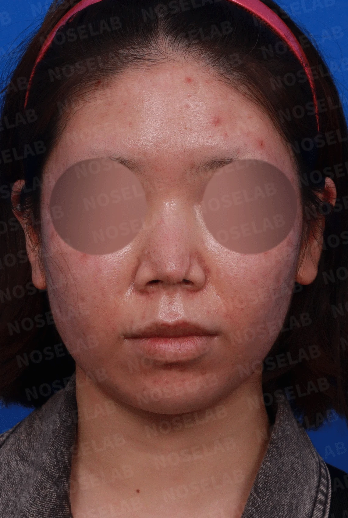 콧구멍을 막는 종괴가 생기는 이유, 제거와 재건은 어떻게 하나 — 디자인 상담 정면 , 좌측 비스듬한 측면 , 측면 사진입니다.