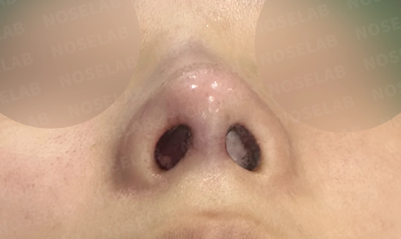 작은 콧날개 연골과 처진 코끝, 자가늑연골과 외측절골술로 자연스럽게 교정 — 전(좌) 직후(후)
