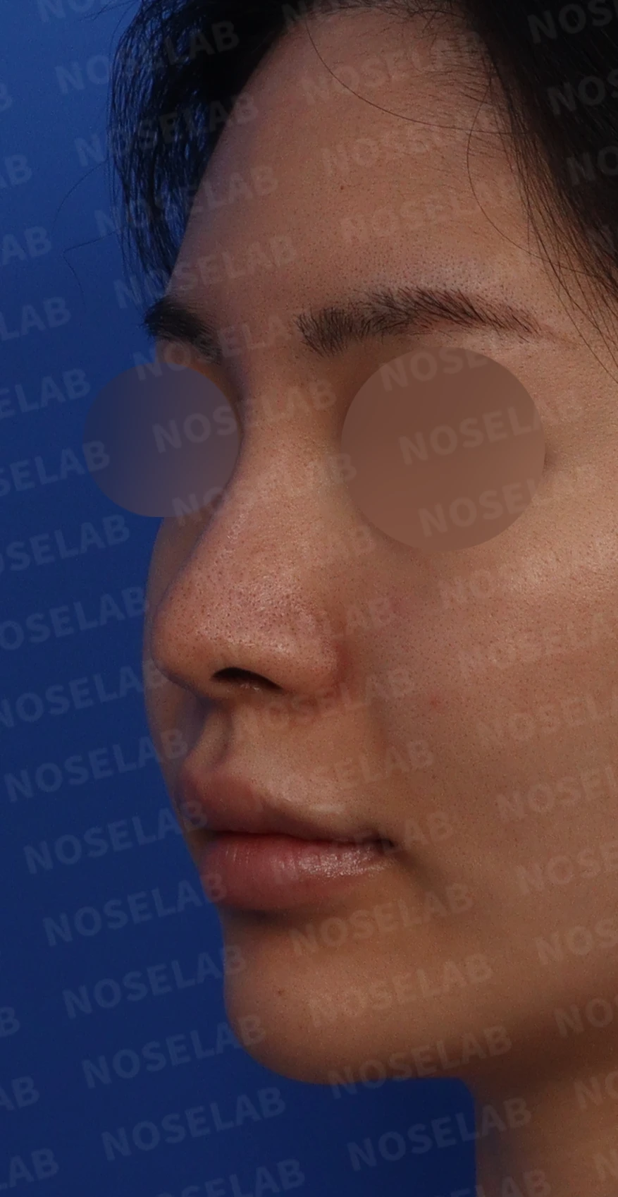 여러 코 모양 고민을 함께 살펴보는 코성형 계획 — 수술전 디자인 정면, 좌측 비스듬한 측면, 측면 사진입니다.
