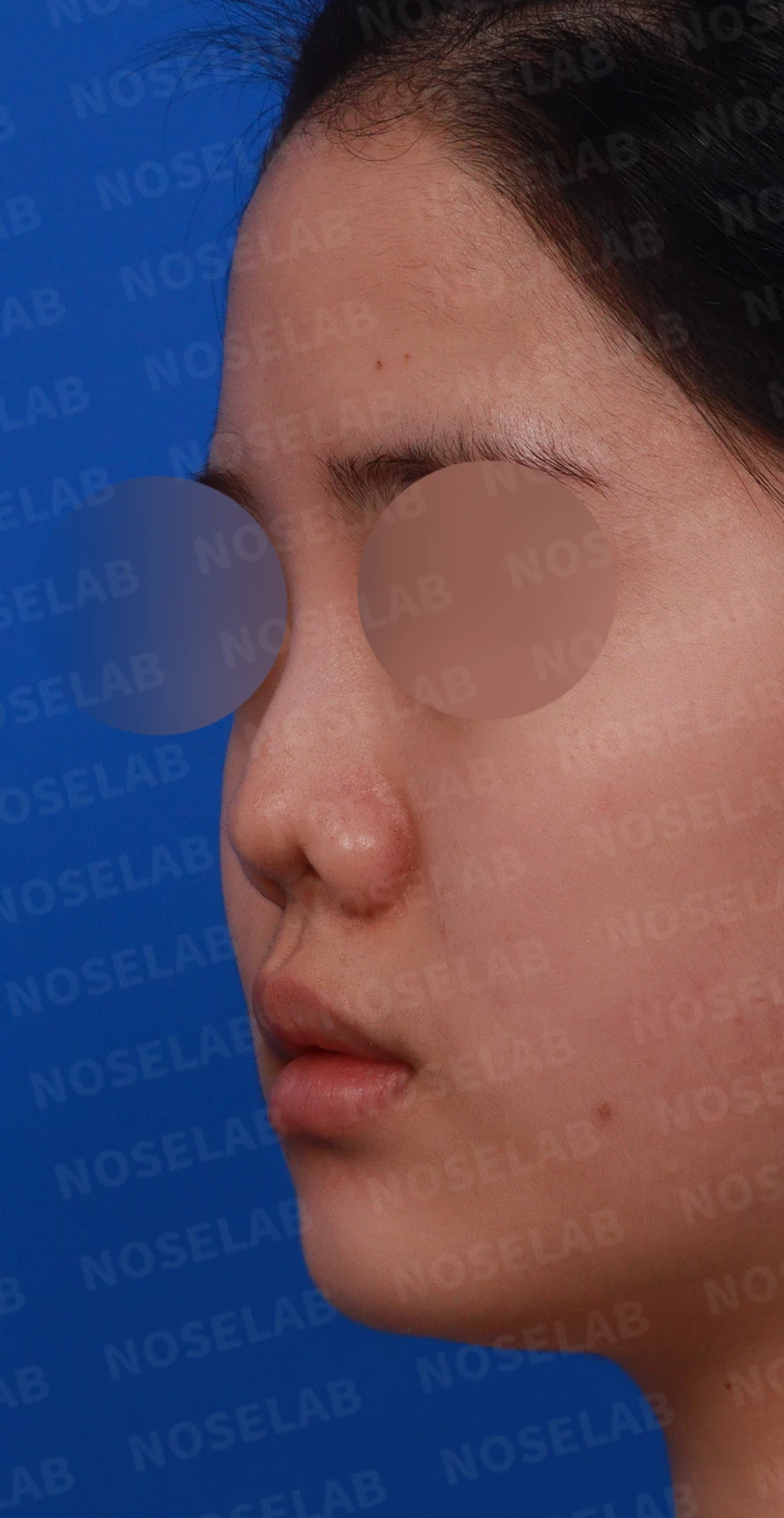 이전 수술 뒤 콧구멍이 좁아지는 비공협착, 원인과 재건 방법 — 디자인 상담 정면, 좌측 측면, 비스듬한 측면 사진입니다.