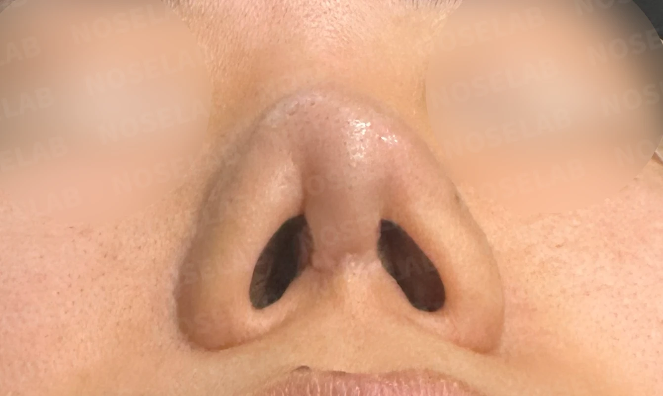 코성형 뒤 감염이 반복되는 이유, 염증 치료와 단계적 재건은 어떻게 하나 — 수술 전 / 수술 직후 0일 직후 사진은 부기가 있는 상태로 최종 결과와 다를 수 있습니다.