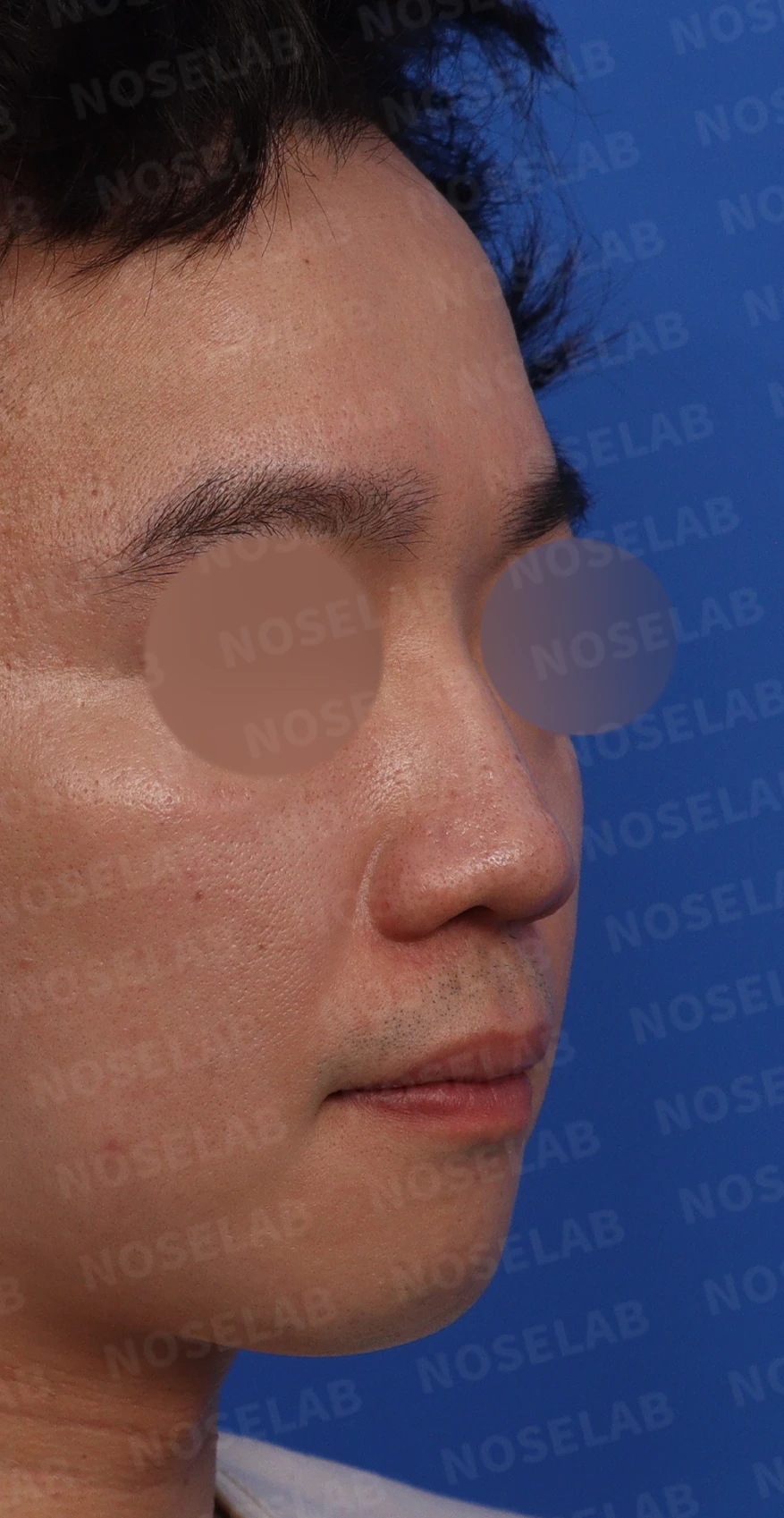 복코와 퍼진 코의 코성형 방법 — 디자인 상담 때 찍은 정면, 측면, 비스듬한 측면 사진입니다.