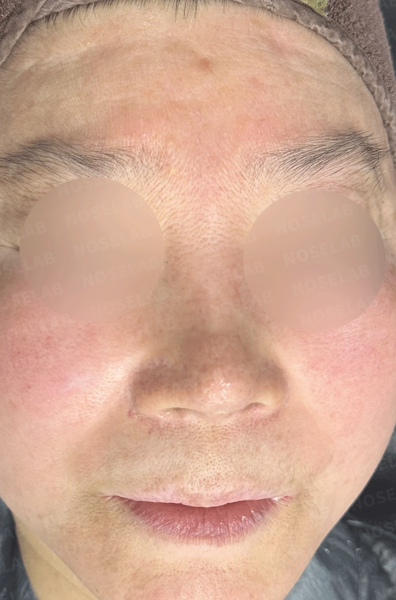 오래된 코 보형물과 코 통증, 재수술에서 확인할 점 — 본문 사진 7