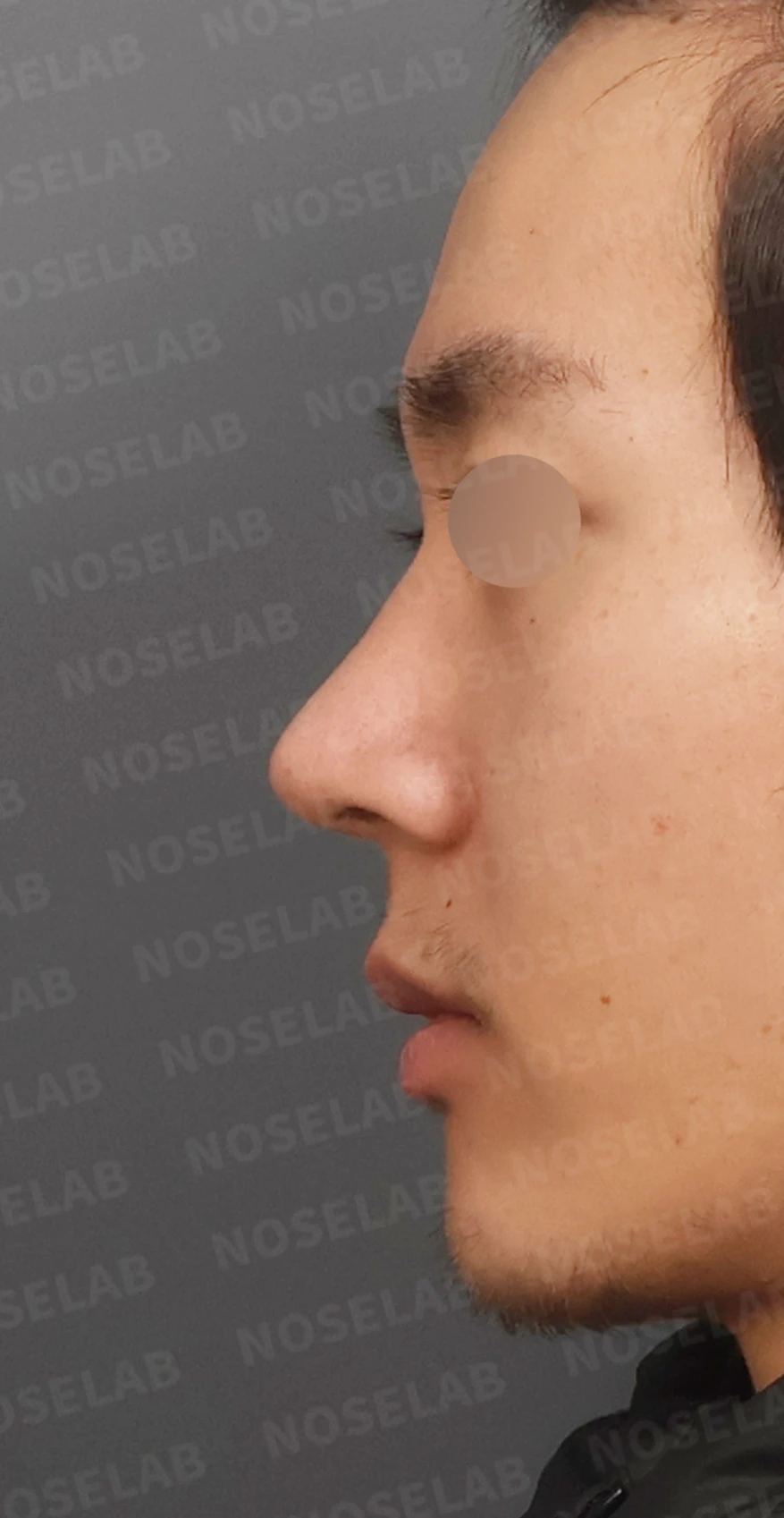 짧고 들린 코, 자가늑연골로 남성적인 라인으로 완성한 코재수술 — 디자인 상담 정면, 비스듬한 측면 , 측면 사진입니다.