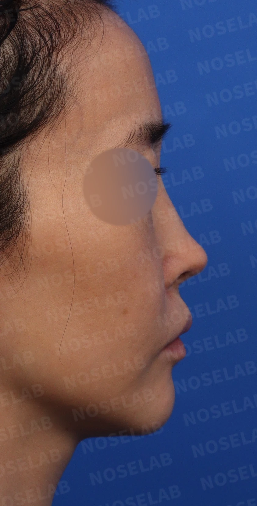 휜코와 콧구멍 비대칭의 재수술 방법 — 수술전 디자인 상담 우측 측면, 비스듬한 측면, 콧구멍 사진입니다.