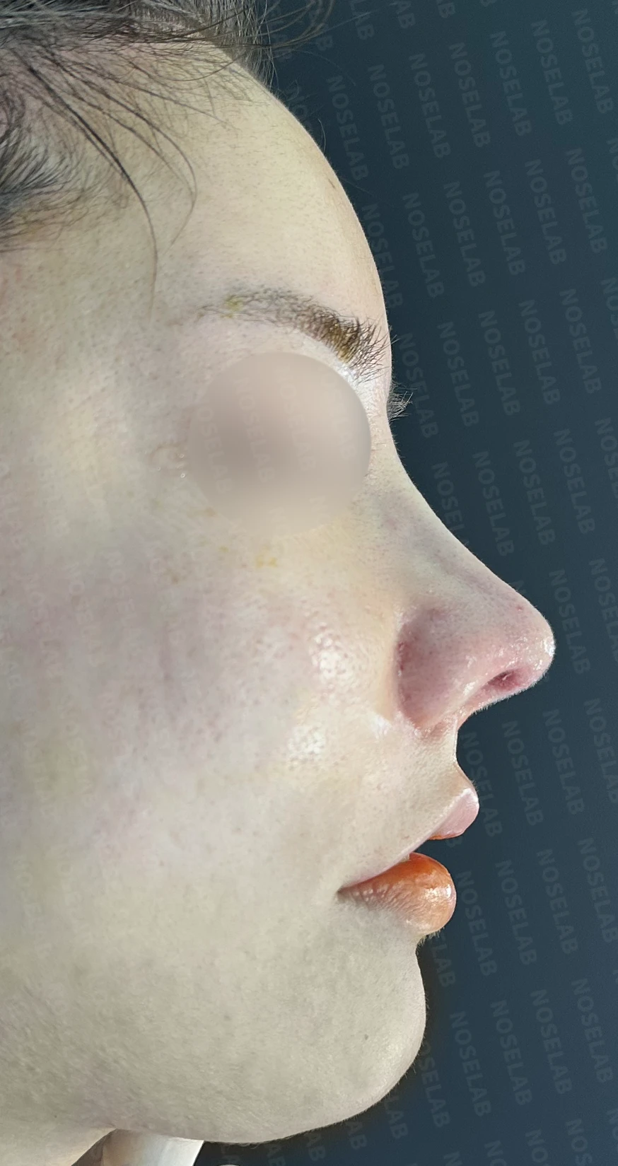복코 교정과 비주 내리기 방법 — 수술 직후 0일 사진 정면, 비스듬한 측면, 측면 직후 사진은 부기가 있는 상태로 최종 결과와 다를 수 있습니다.