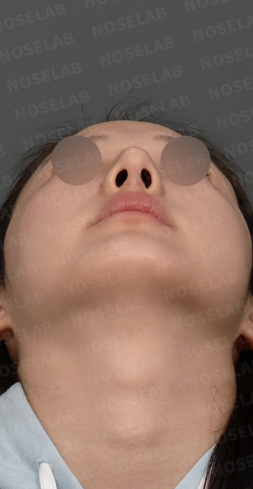 코재수술, 휘어진 코뼈와 매부리코를 외측 절골술과 자가늑연골로 자연스럽게 교정 — 디자인 상담 우측 측면, 비스듬한 측면, 비공 사진입니다.