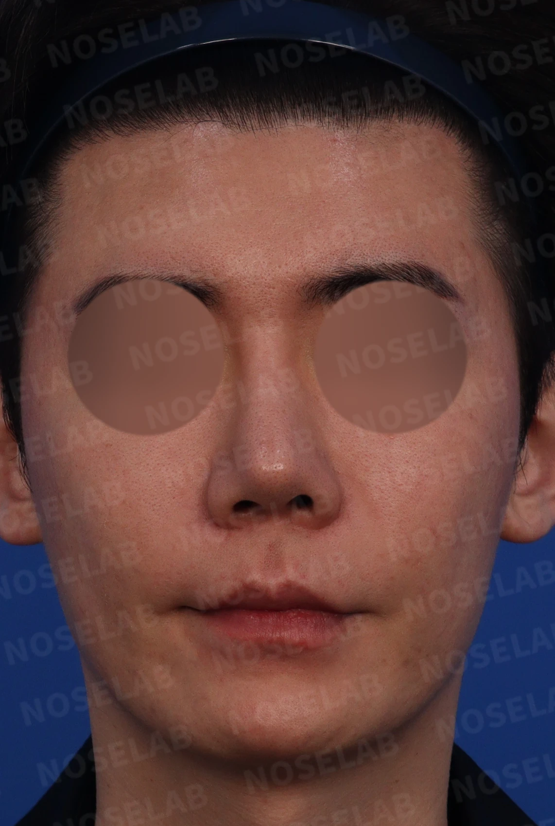 수술한 티가 나는 실리콘 보형물 교체 맞춤 코성형 방법 — 디자인 상담 정면, 측면, 비스듬한 측면