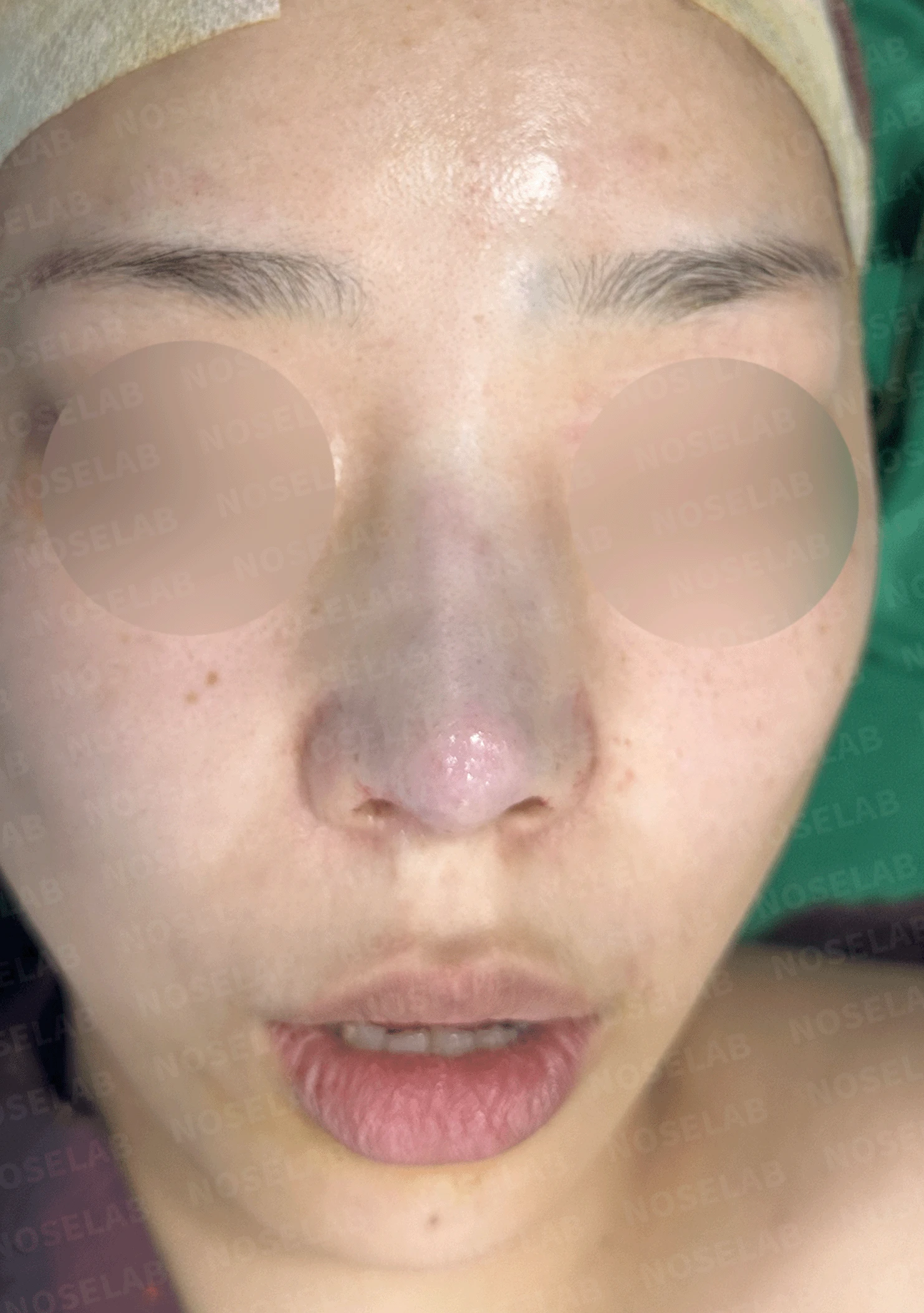 여러 번 수술한 코에 연골이 비치는 이유와 점막·구조 복원 방법 — 수술 직후 0일 정면 , 측면 , 비스듬한 측면 사진입니다. 직후 사진은 부기가 있는 상태로 최종 결과와 다를 수 있습니다.
