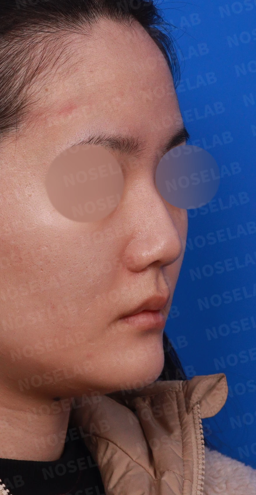 양악수술 뒤 코가 휘고 코끝이 뭉툭해지는 이유, 자가 늑연골로 매부리 라인을 만드는 방법 — 디자인 상담 우측 비스듬한 측면, 측면, 비공 사진