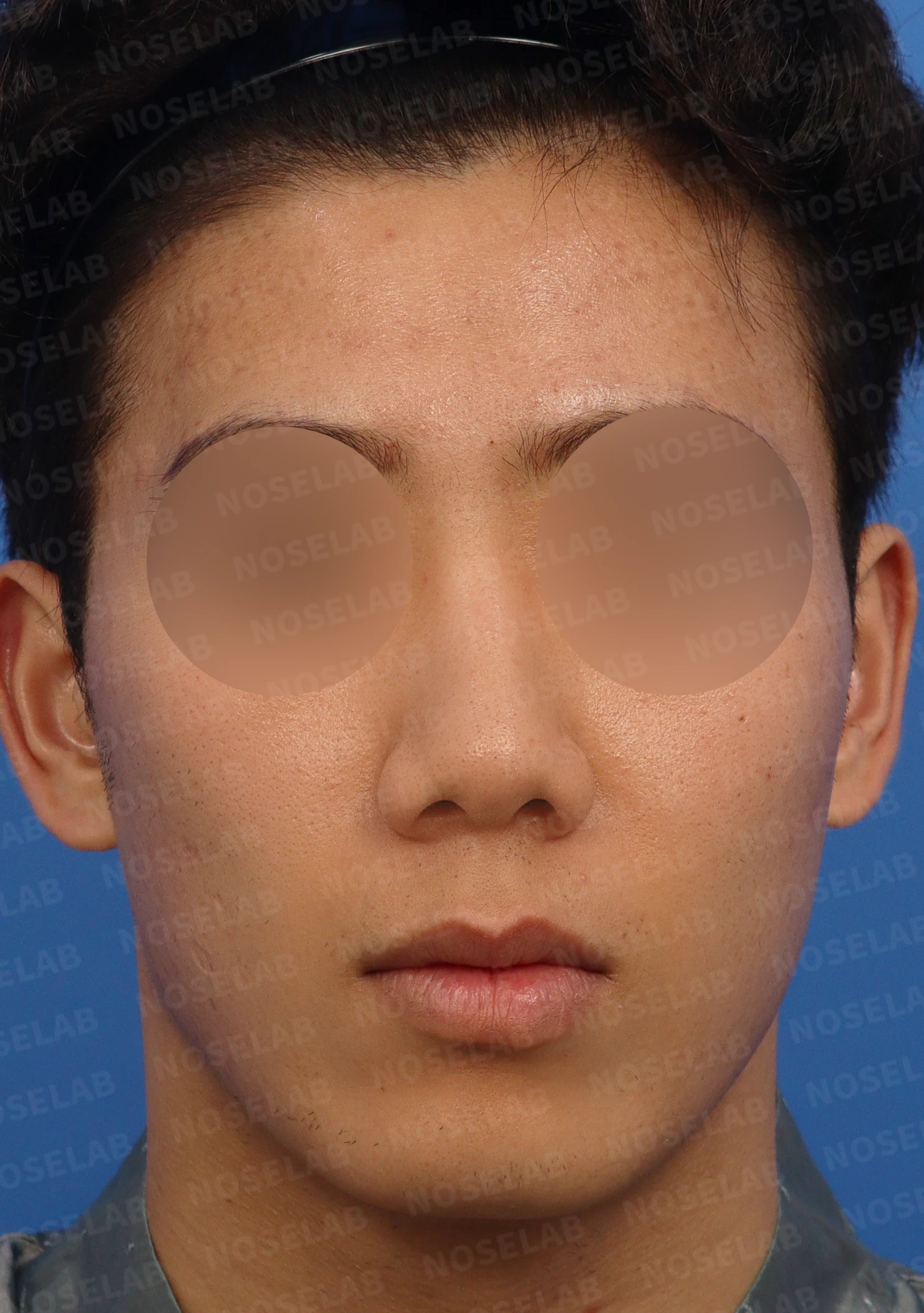 복코 교정과 비주 내리기를 함께 계획하는 방법 — 본문 사진 1