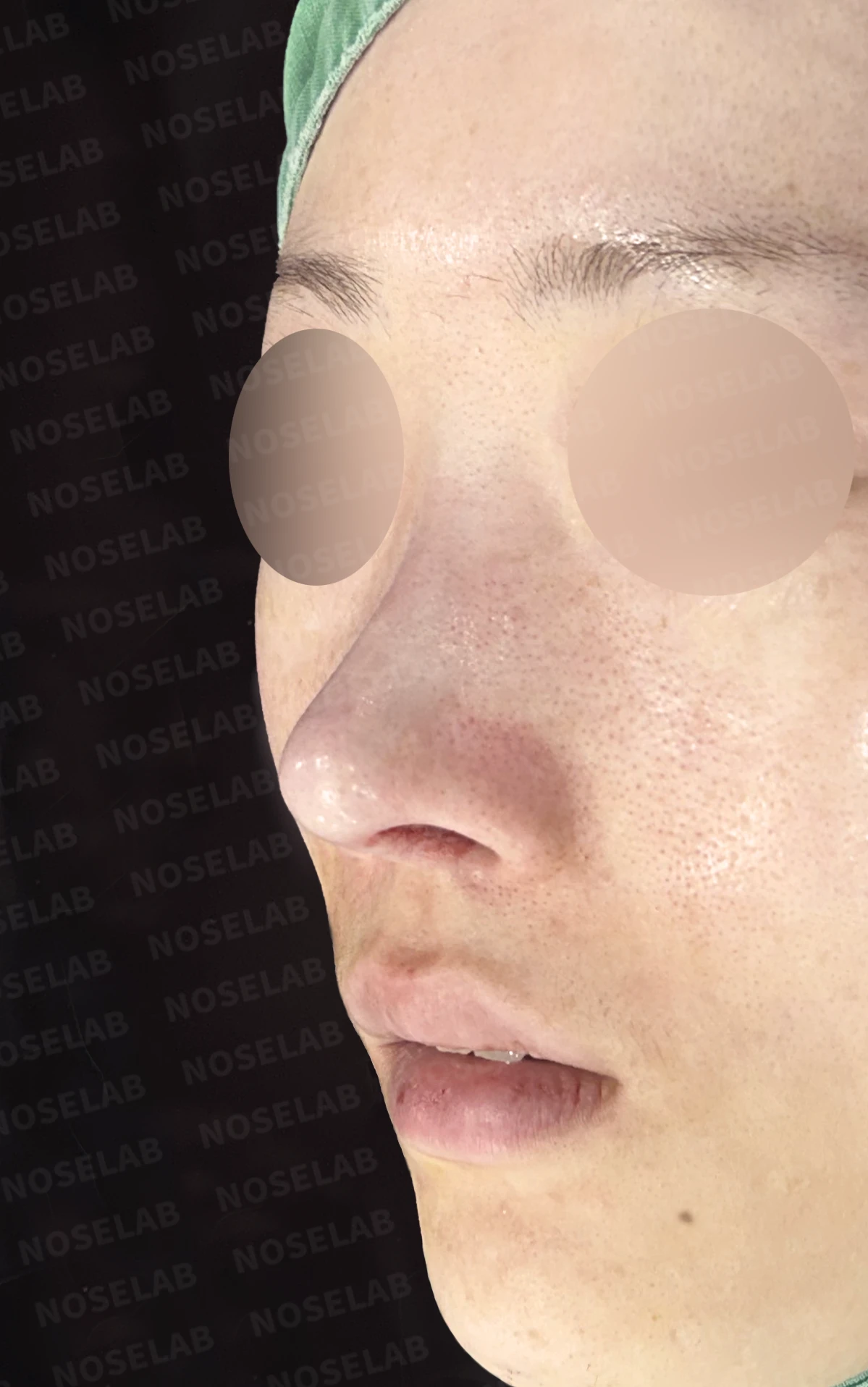 보형물 비침과 들린 코, 자가늑연골로 안전하게 교정한 코재수술 — 직후 정면 , 비스듬한 측면 , 측면 사진입니다.