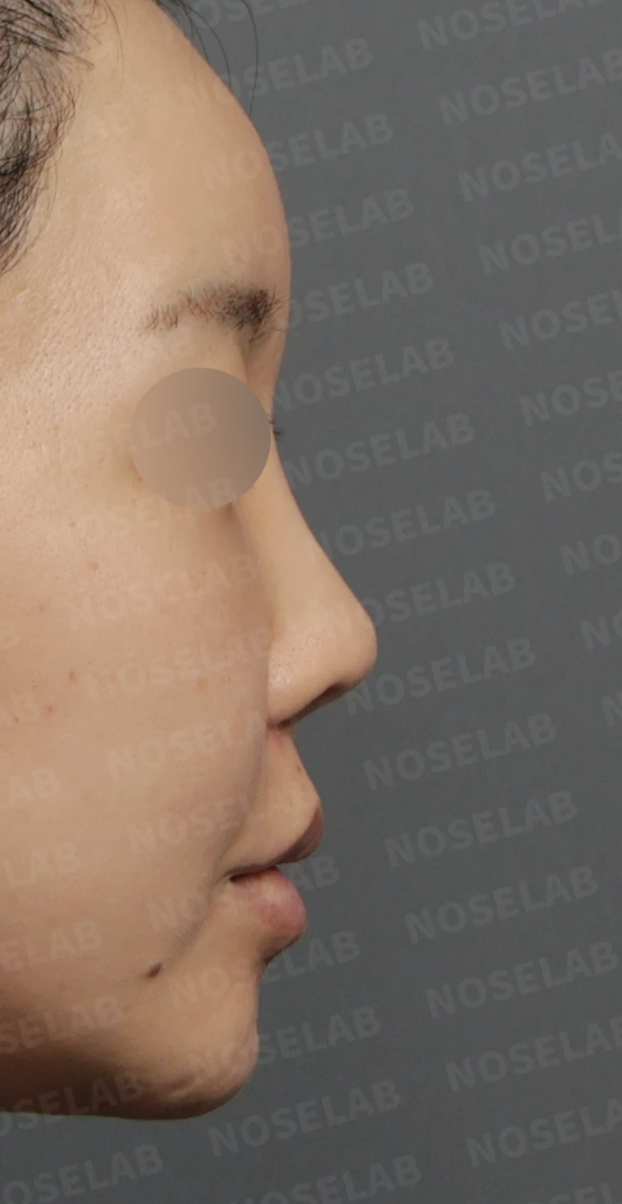 짧고 들린 코, 자가늑연골로 비중격 재건한 코재수술 사례 — 디자인 상담 우측 측면 , 비스듬한 측면 , 비공 사진입니다