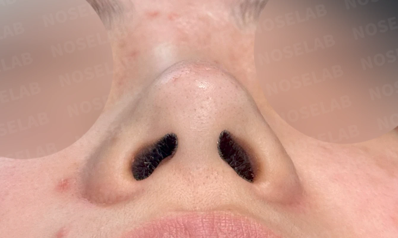 코에 주입된 필러와 실을 제거하고 재건하는 방법 — 수술 전 / 수술 직후 0일 직후 사진은 부기가 있는 상태로 최종 결과와 다를 수 있습니다.