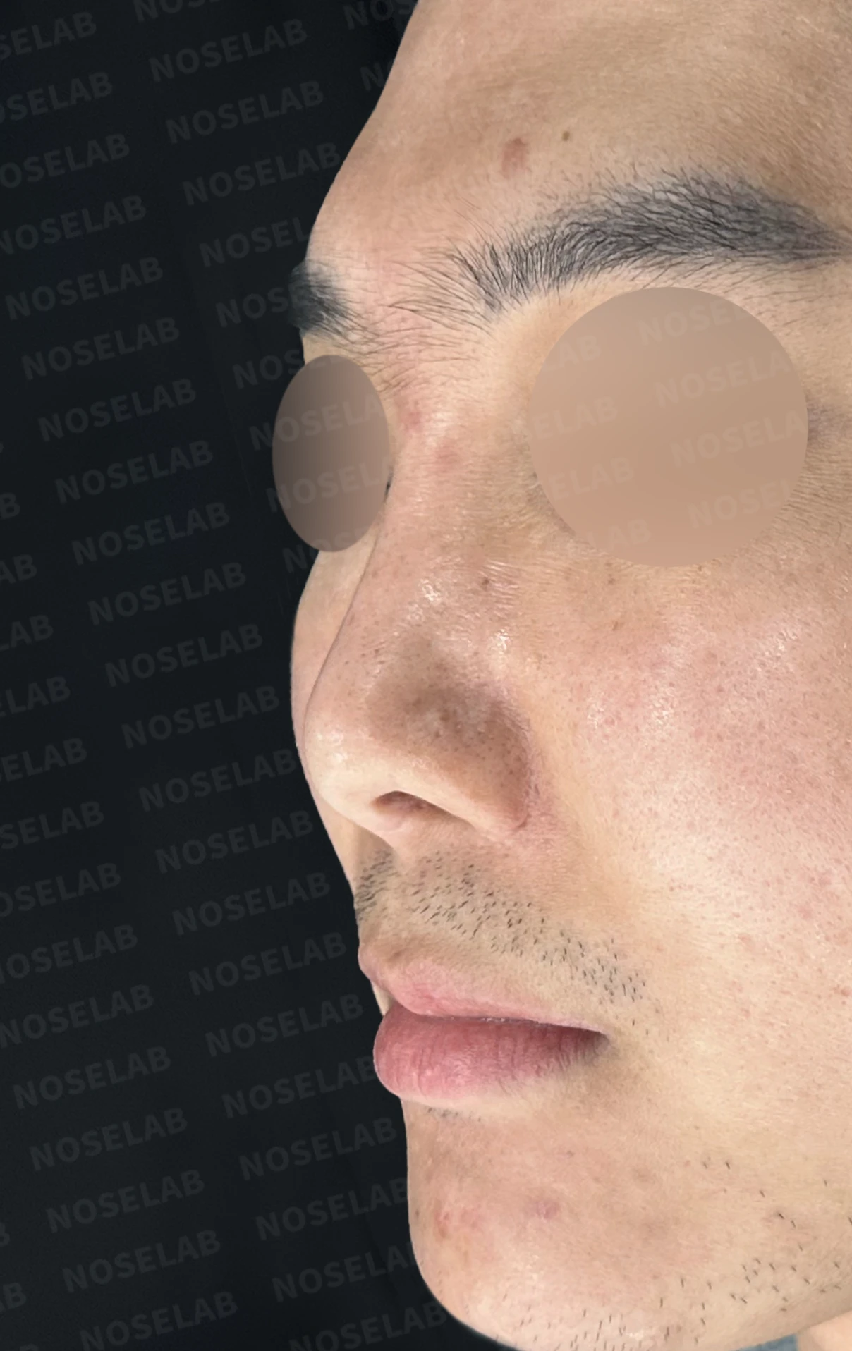 휜코 교정과 비공 비대칭, 자가늑연골로 바로잡은 코재수술 — 전(좌) 직후(후)
