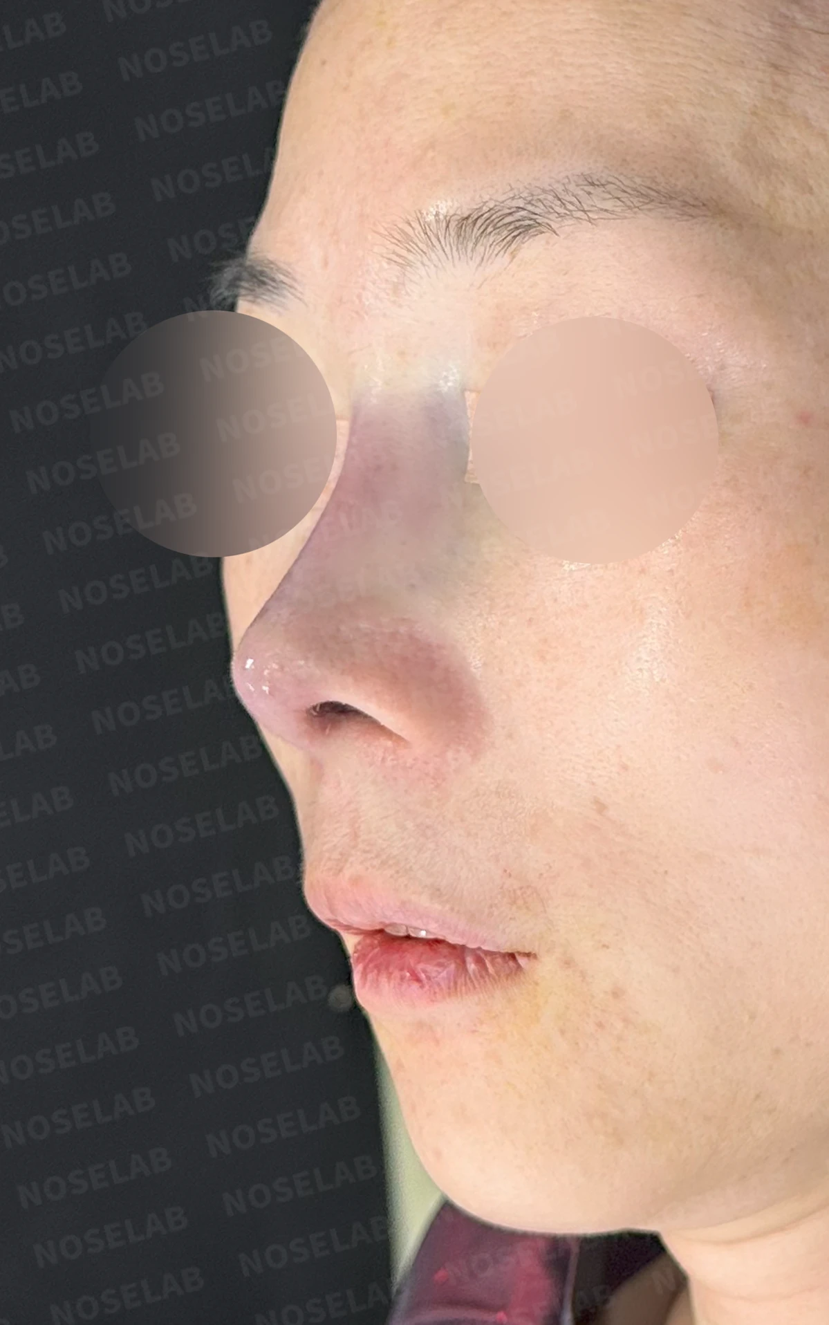 오래된 실리콘 피막이 석회화되면 왜 매부리와 휜 코가 생기나 — 수술 직후 0일 정면 , 비스듬한 측면 , 측면 사진입니다. 직후 사진은 부기가 있는 상태로 최종 결과와 다를 수 있습니다.
