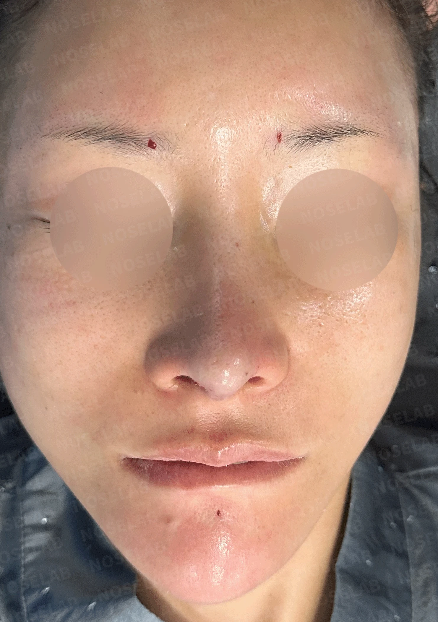 후비루와 코끝 처짐이 함께 나타나는 이유, 비중격 연장과 기능 수술은 어떻게 하나 — 본문 사진 8
