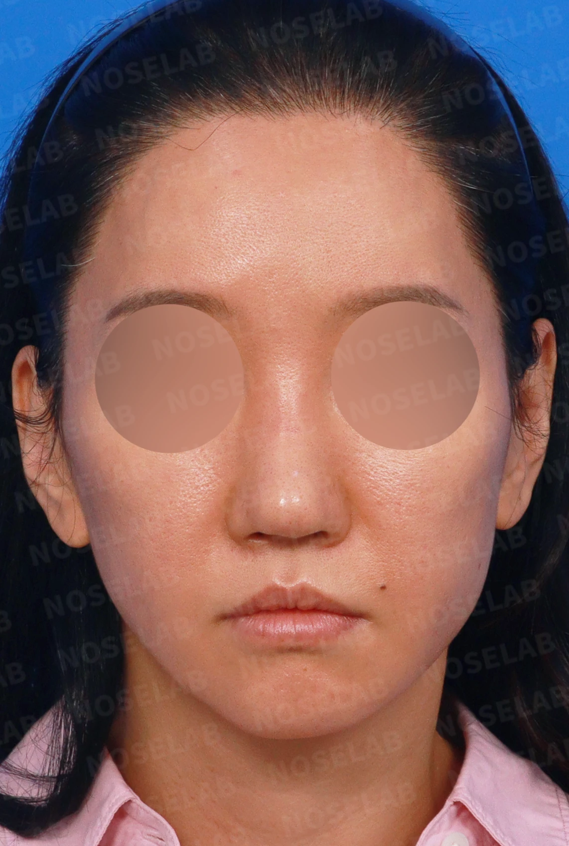 여러 번의 코재수술 뒤 비중격이 무너지는 이유, 자가늑연골 전면 재건은 어떻게 하나 — 디자인 상담 정면, 좌측 측면, 비스듬한 측면 사진입니다.