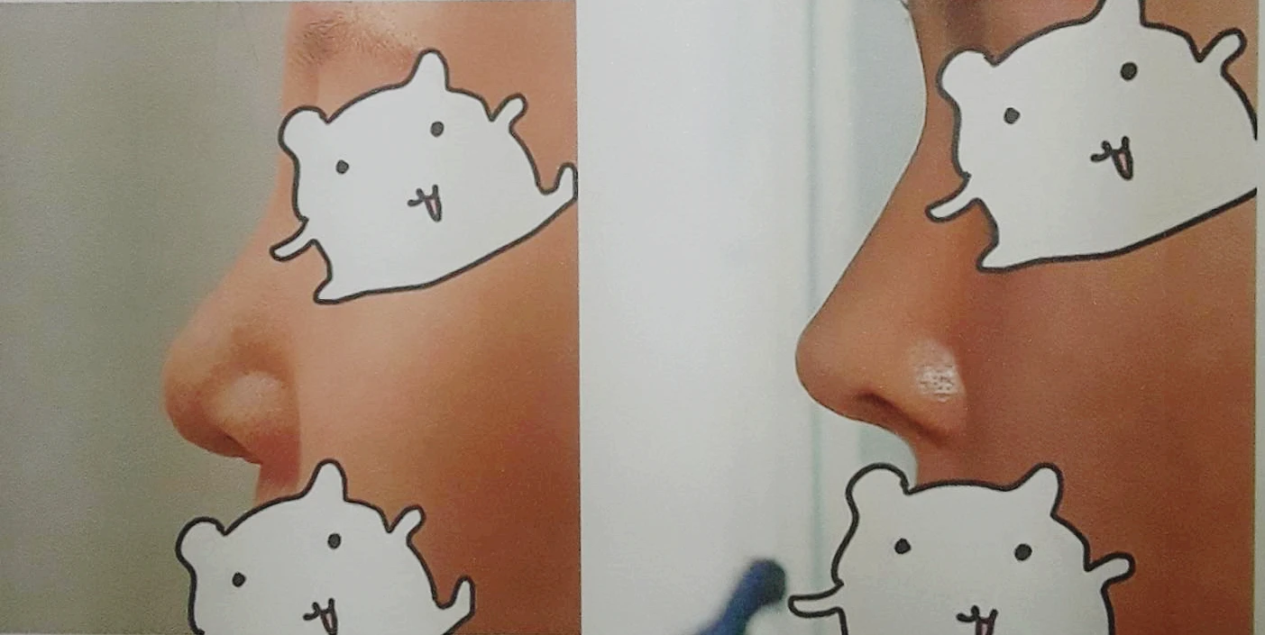 코끝 처짐과 코막힘을 함께 살펴보는 재수술 방법 — 환자분이 원하시는 사진들입니다.
