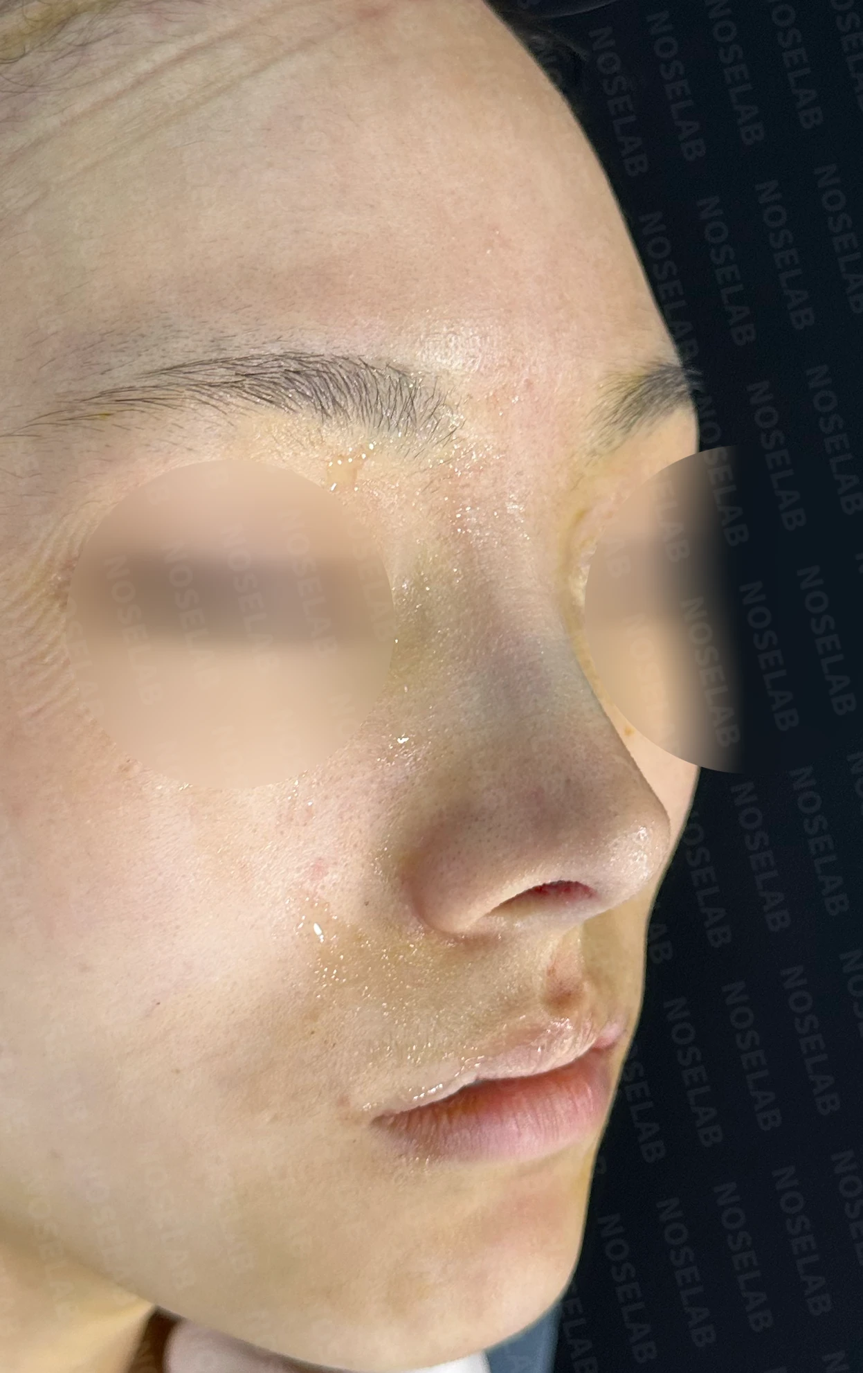 긴코·퍼진코 교정 방법 — 수술 직후 0일 정면, 비스듬한 측면, 측면 사진 직후 사진은 부기가 있는 상태로 최종 결과와 다를 수 있습니다.