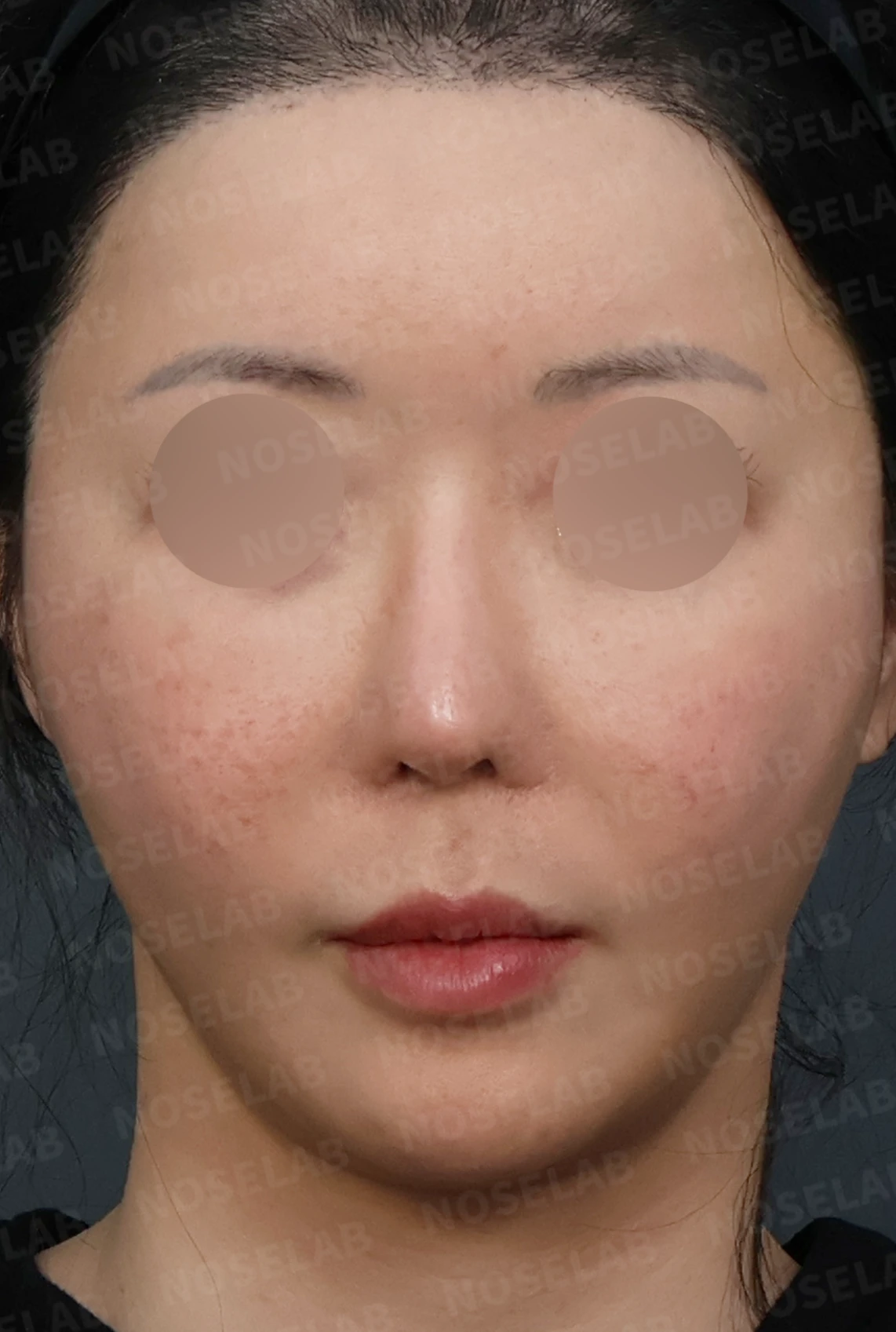코성형 뒤 코막힘이 더 심해지는 이유, 비중격 재건과 절골 복원은 어떻게 하나 — 디자인 상담 정면, 좌측 측면, 비스듬한 측면 사진입니다.