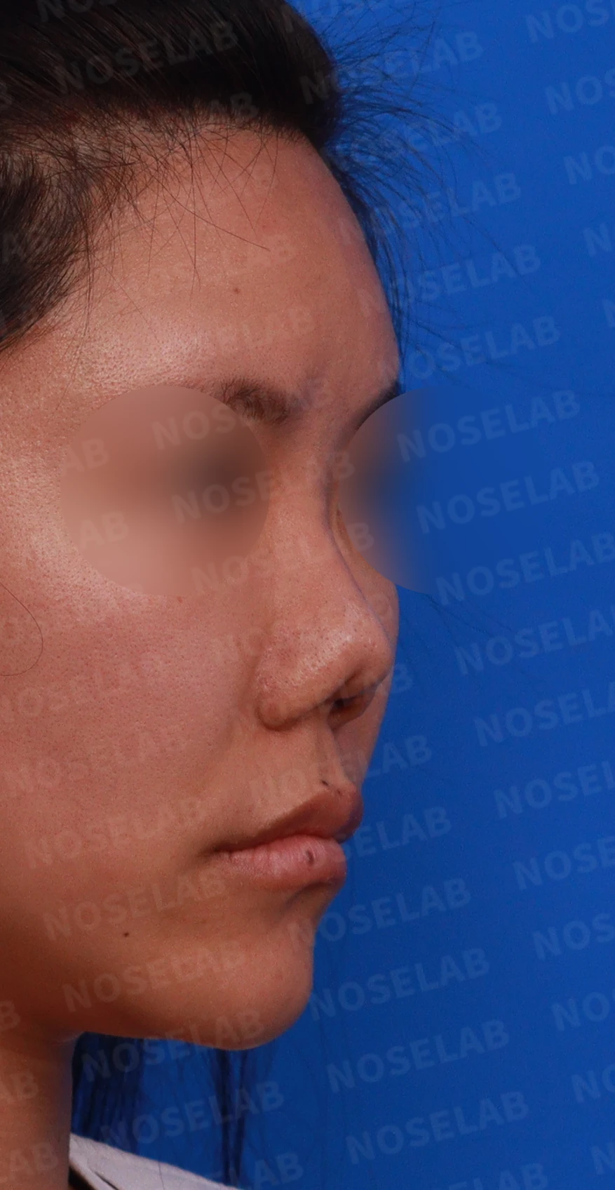 코성형 뒤 감염이 반복되는 이유, 염증 치료와 단계적 재건은 어떻게 하나 — 디자인 상담 우측 측면 , 비스듬한 측면 , 비공 사진입니다.