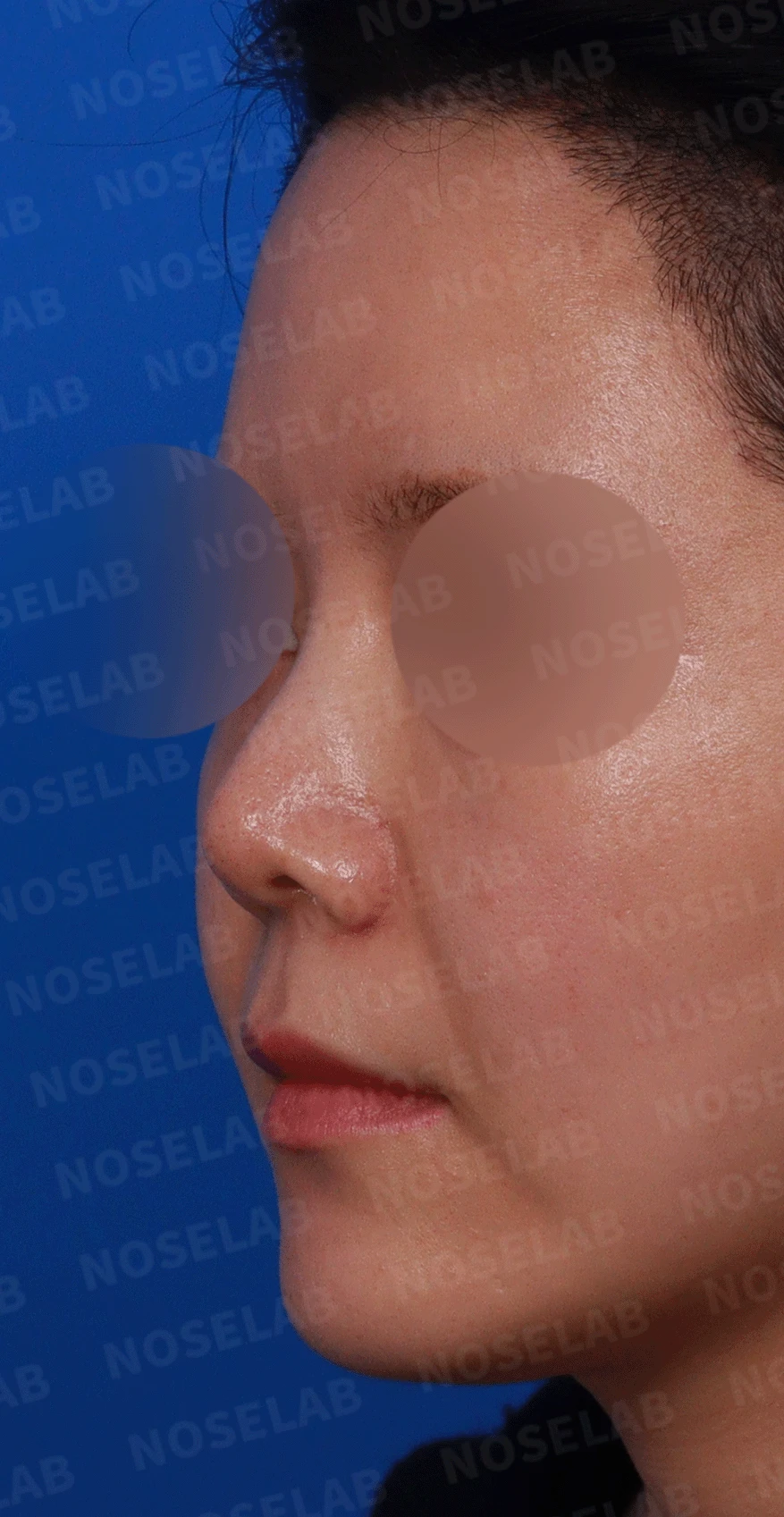 늑연골 석회화를 미리 확인해야 하는 이유와 휜코·짧은코 교정 방법 — 디자인 상담 정면 , 좌측 측면 , 비스듬한 측면 사진