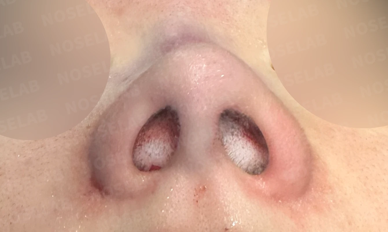 필러와 실 시술 뒤 코가 뭉툭해지는 이유, 이물질 제거와 코끝 교정 방법 — 수술 직후 0일 비공 사진 직후 사진은 부기가 있는 상태로 최종 결과와 다를 수 있습니다.