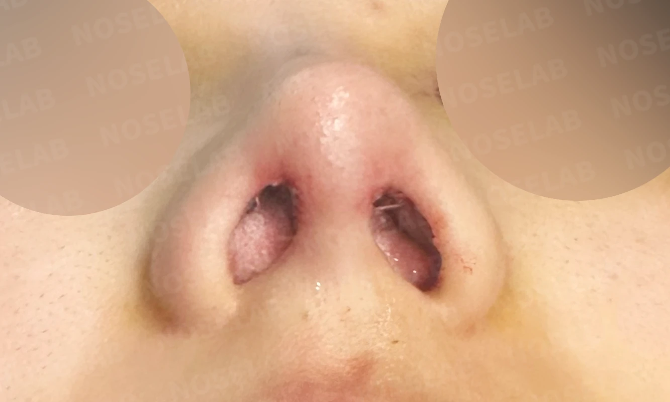 작은 코와 비공 비대칭을 함께 살펴보는 교정 방법 — 비공 사진