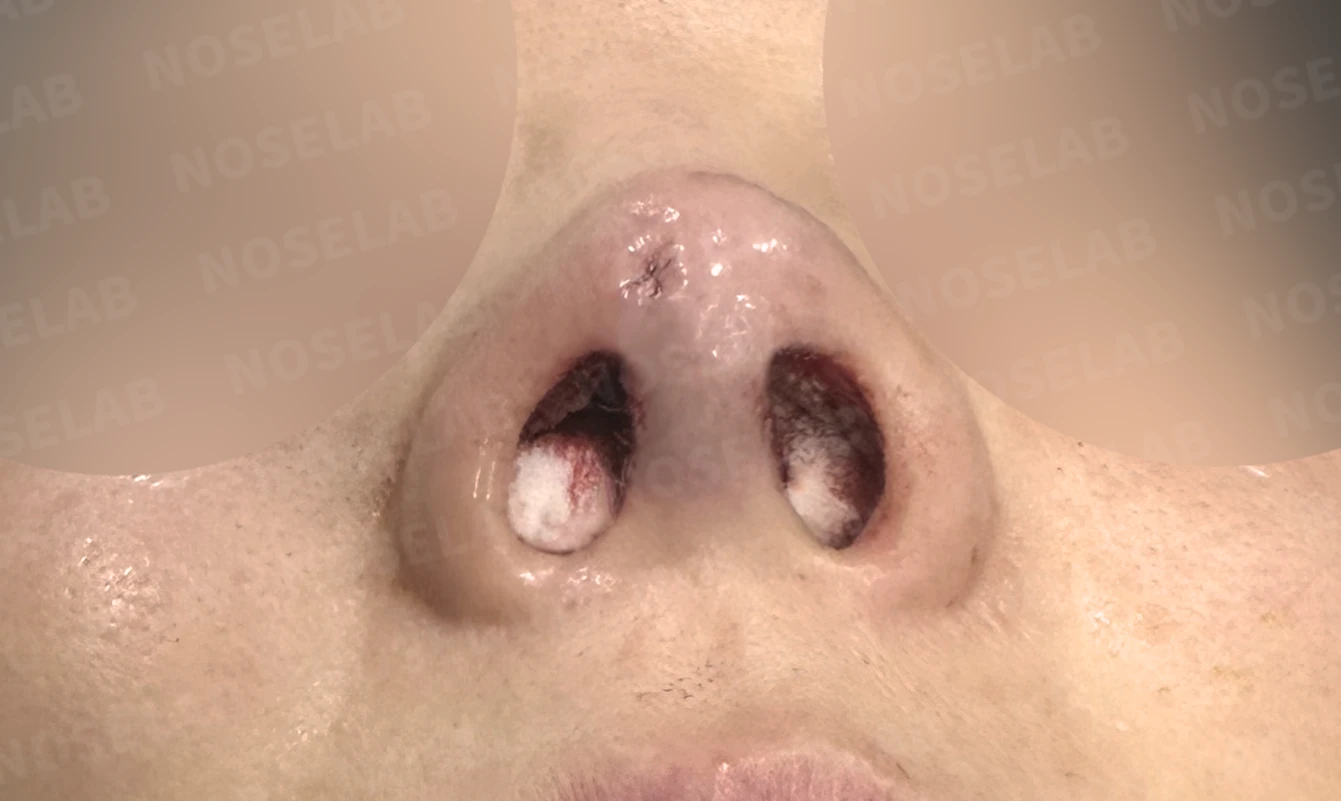 코끝 피부 함몰과 보형물 비침, 자가늑연골로 안전하게 복원한 코재수술 — 전(좌) 직후(우)