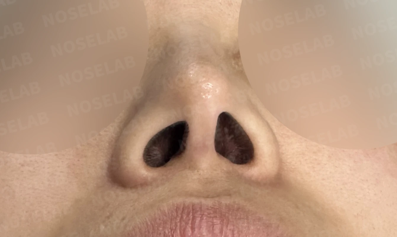 비공 비대칭과 휘어진 코, 자가늑연골 재건으로 교정한 코재수술 — 전(좌) 직후(후)
